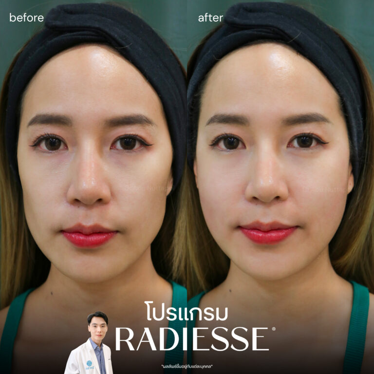 เจาะลึกโปรแกรม Radiesse Filler คืออะไร ราคาเท่าไหร่ ต้องฉีดกี่ครั้งเพื่อฟื้นฟูผิว 5 radiesse-review-1
