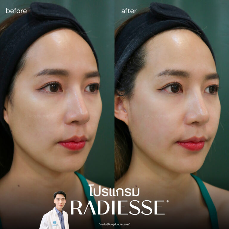 เจาะลึกโปรแกรม Radiesse Filler คืออะไร ราคาเท่าไหร่ ต้องฉีดกี่ครั้งเพื่อฟื้นฟูผิว 6 radiesse-review