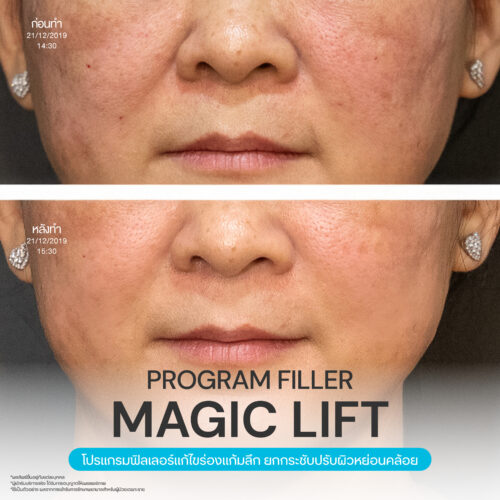 โปรแกรมฟิลเลอร์ยกกระชับช่วยปรับรูปหน้าให้ละมุน 3 Magic Lift 26 1