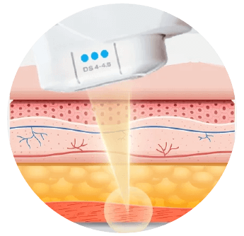 Ulthera Program by Infiniz Clinic 3 แม่นยำสูงสุดทุก Shot