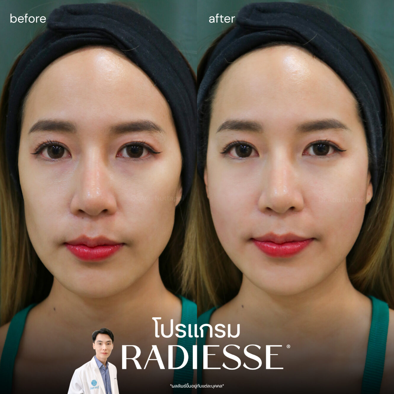 เหตุผลที่ควรฉีด โปรแกรม Radiesse รีวิวแน่น ช่วยเติมเต็มและฟื้นฟูผิว 4 BA Radiesse 01 1