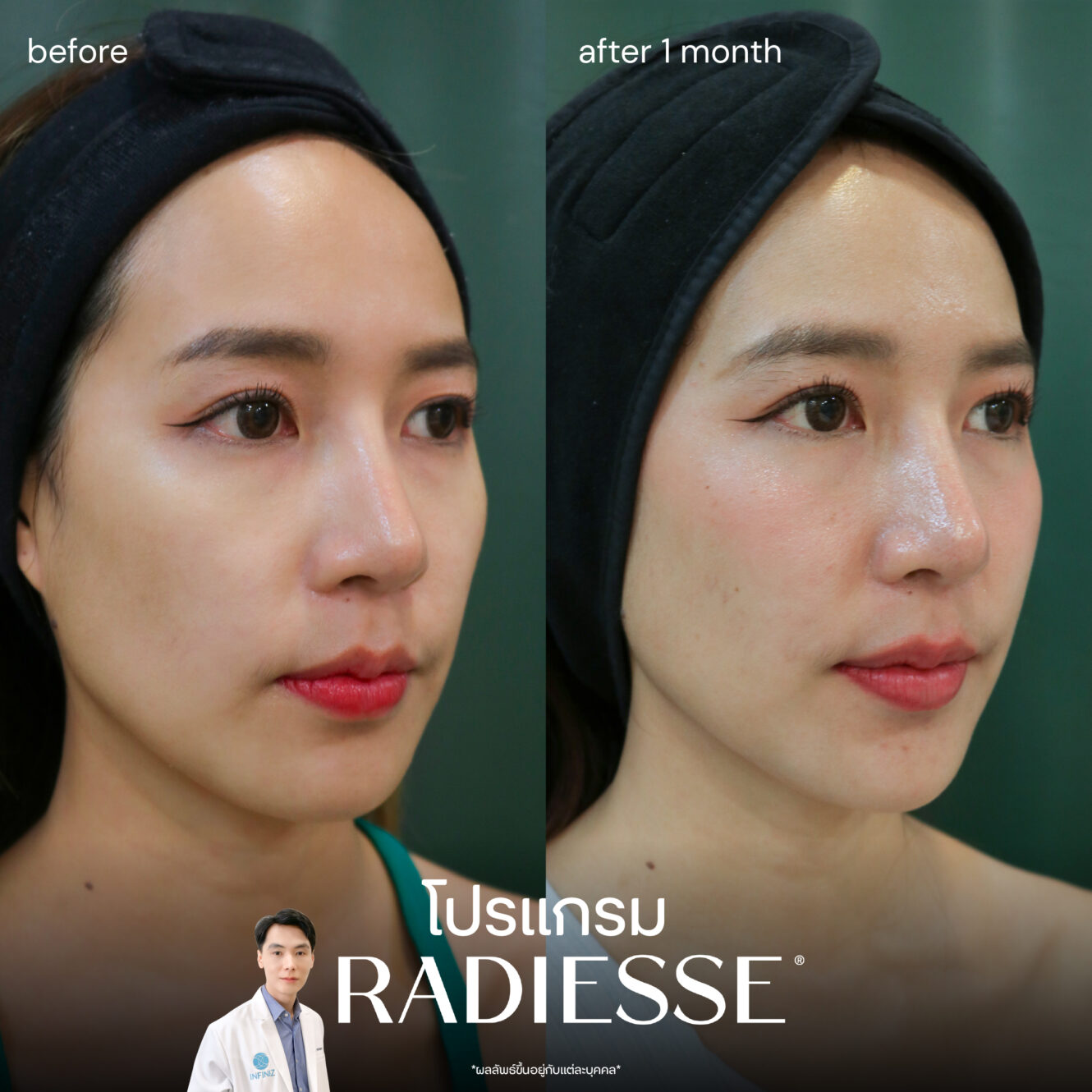 เหตุผลที่ควรฉีด โปรแกรม Radiesse รีวิวแน่น ช่วยเติมเต็มและฟื้นฟูผิว 5 BA Radiesse 03 1