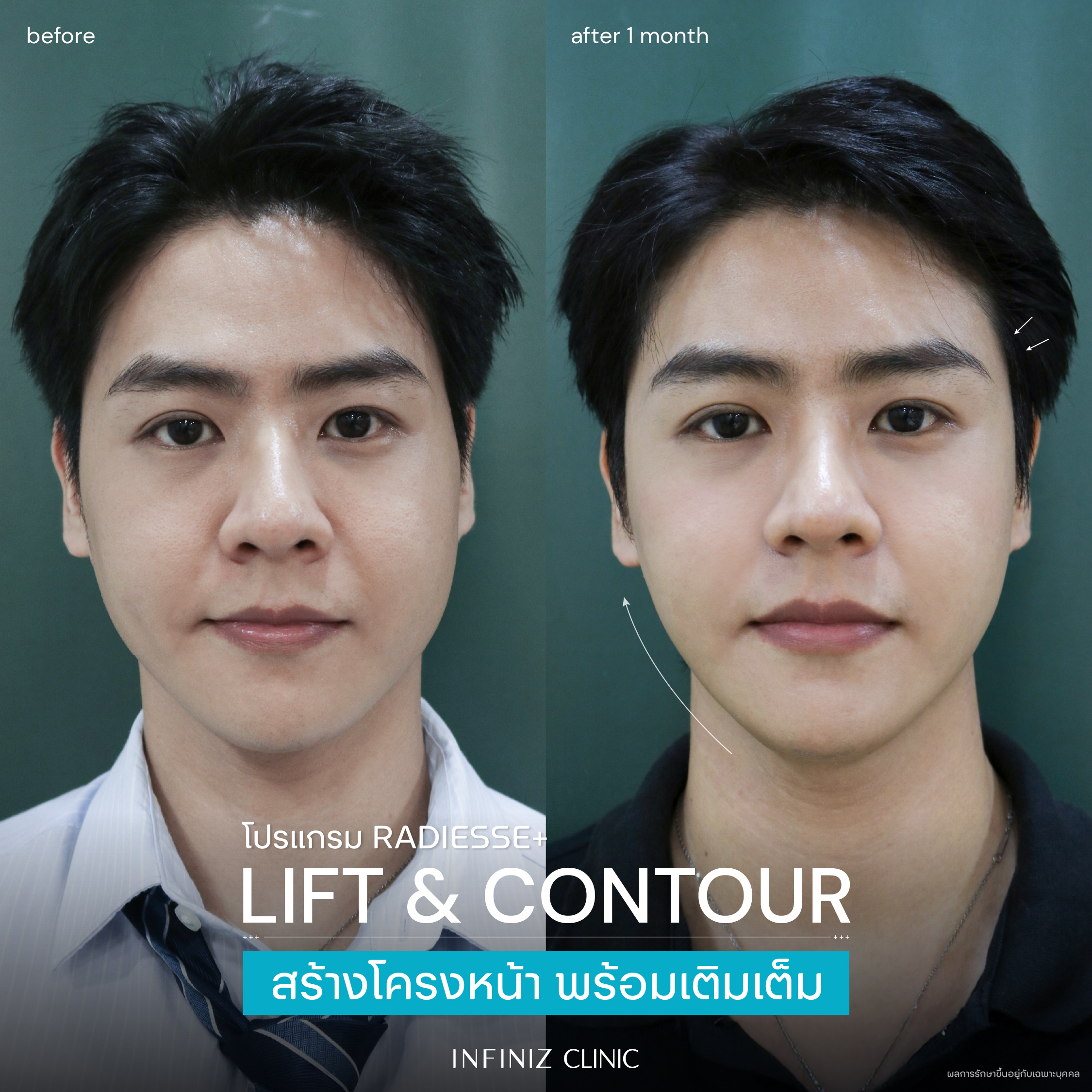 โปรแกรม Radiesse Plus เสริมกรอบหน้าให้คมชัด อย่างมีมิติ 6 BA Radiesse Jan 02 1