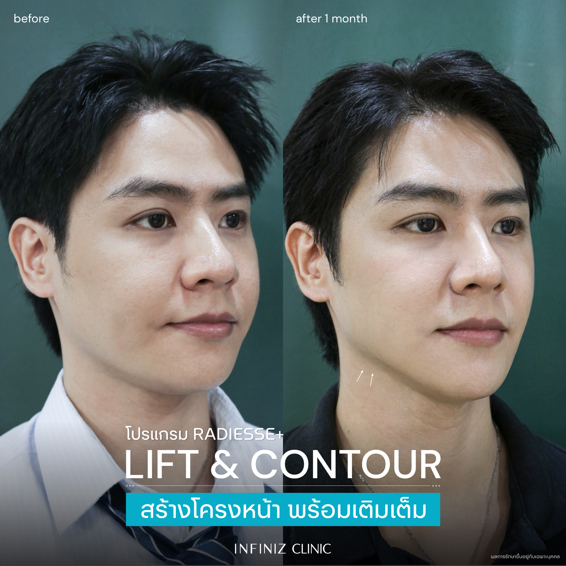 โปรแกรม Radiesse Plus เสริมกรอบหน้าให้คมชัด อย่างมีมิติ 7 BA Radiesse Jan 03 1
