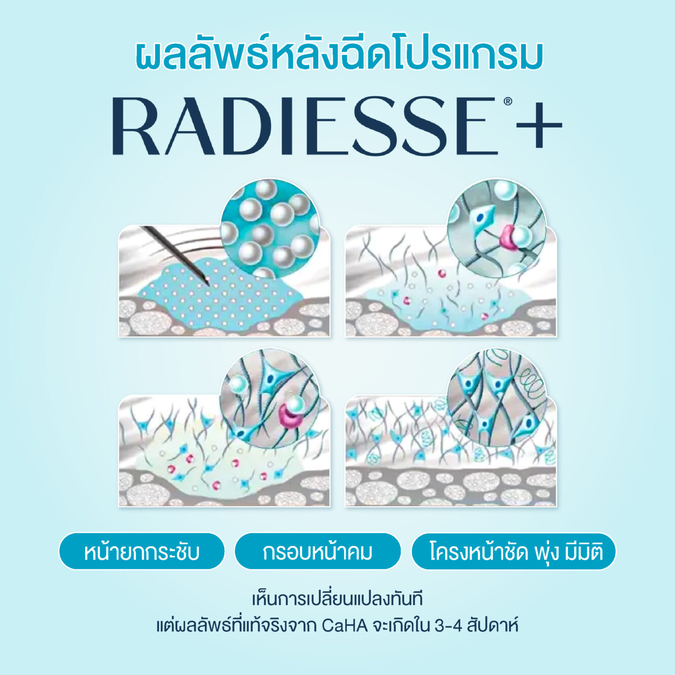 โปรแกรม Radiesse Plus เสริมกรอบหน้าให้คมชัด อย่างมีมิติ 4 Radiess 04