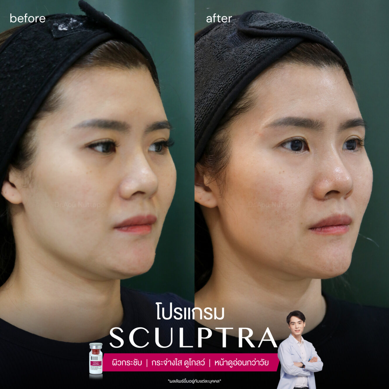 โปรแกรม Sculptra รีวิวจากผู้ที่ฉีด เห็นผลการเปลี่ยนแปลงอย่างไรบ้าง 4 Sculptra-review-3