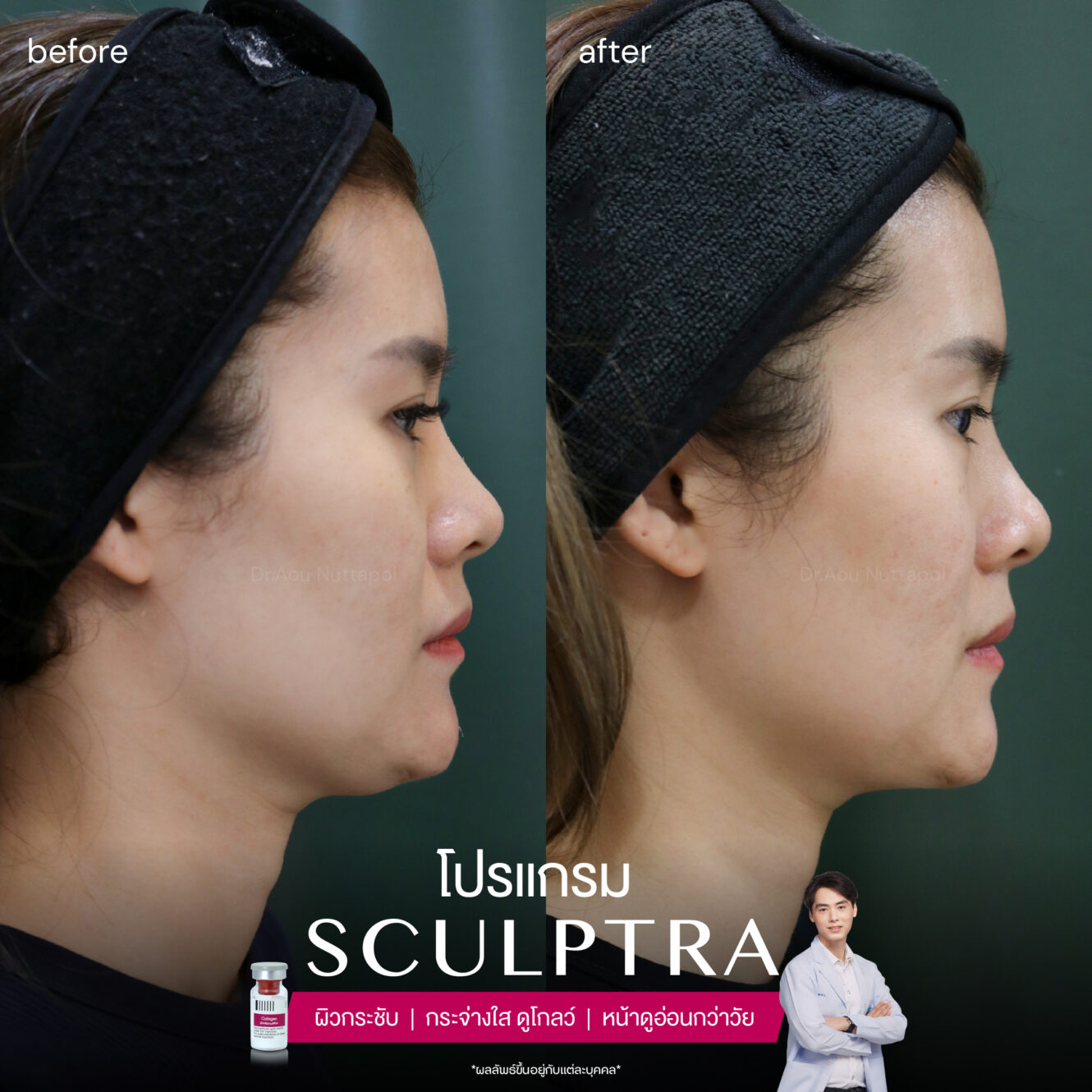 โปรแกรม Sculptra รีวิวจากผู้ที่ฉีด เห็นผลการเปลี่ยนแปลงอย่างไรบ้าง 3 Sculptra-review-2