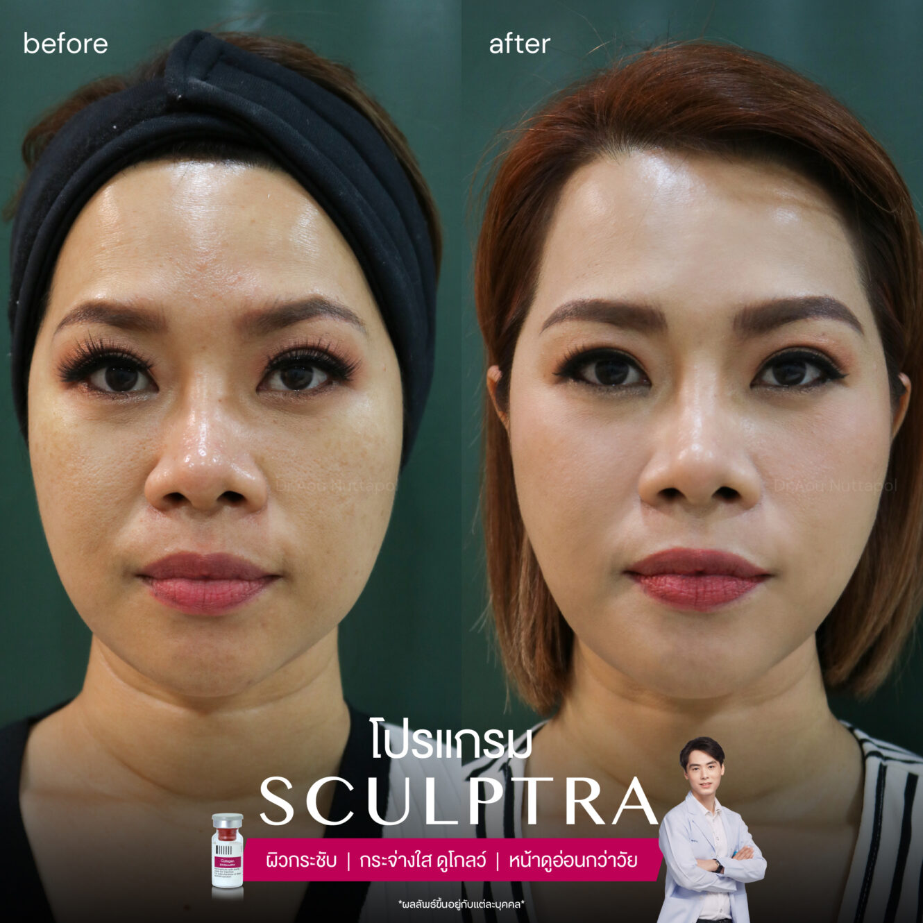 โปรแกรม Sculptra รีวิวจากผู้ที่ฉีด เห็นผลการเปลี่ยนแปลงอย่างไรบ้าง 2 Sculptra-review