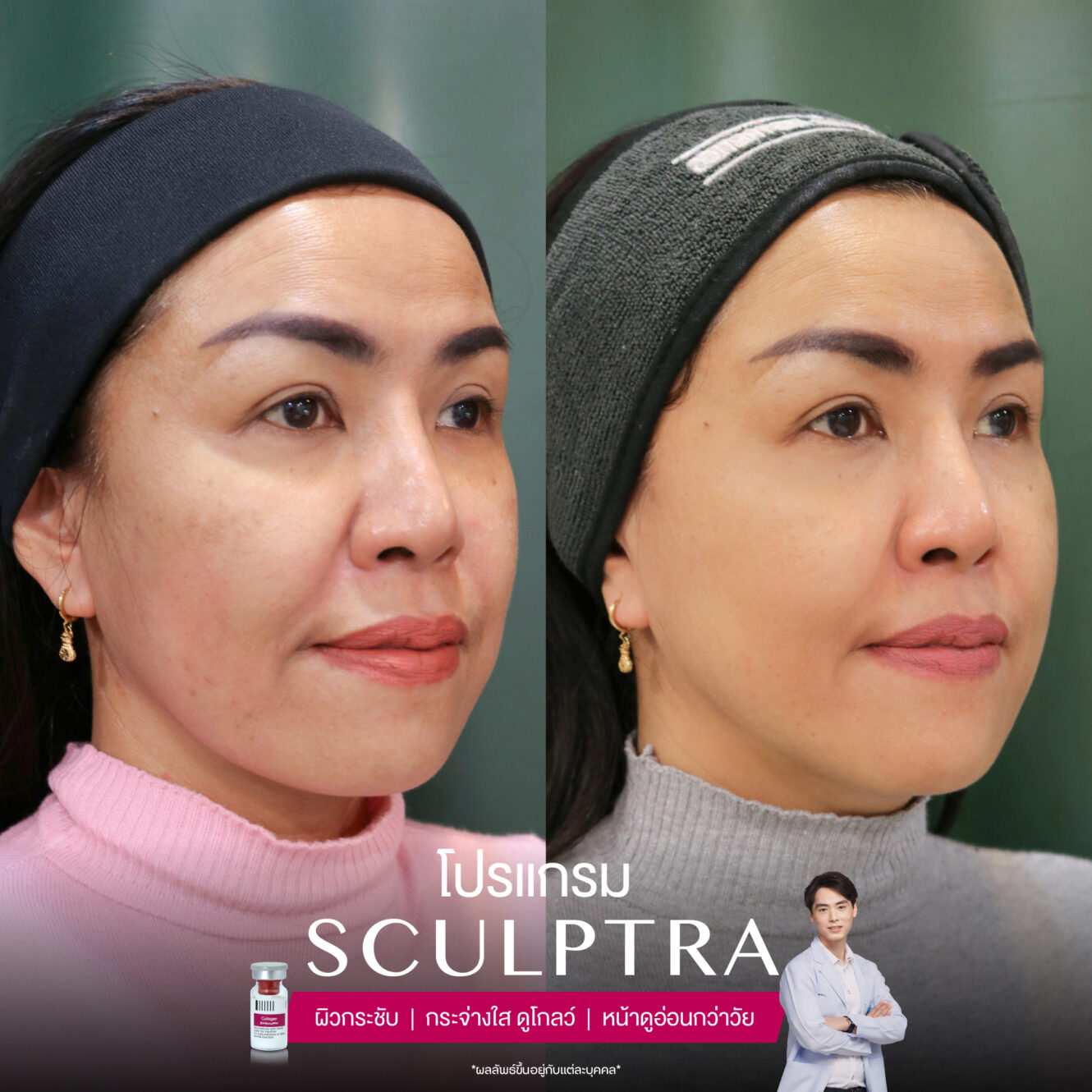 โปรแกรม Sculptra รีวิวจากผู้ที่ฉีด เห็นผลการเปลี่ยนแปลงอย่างไรบ้าง 5 Sculptra-review-4