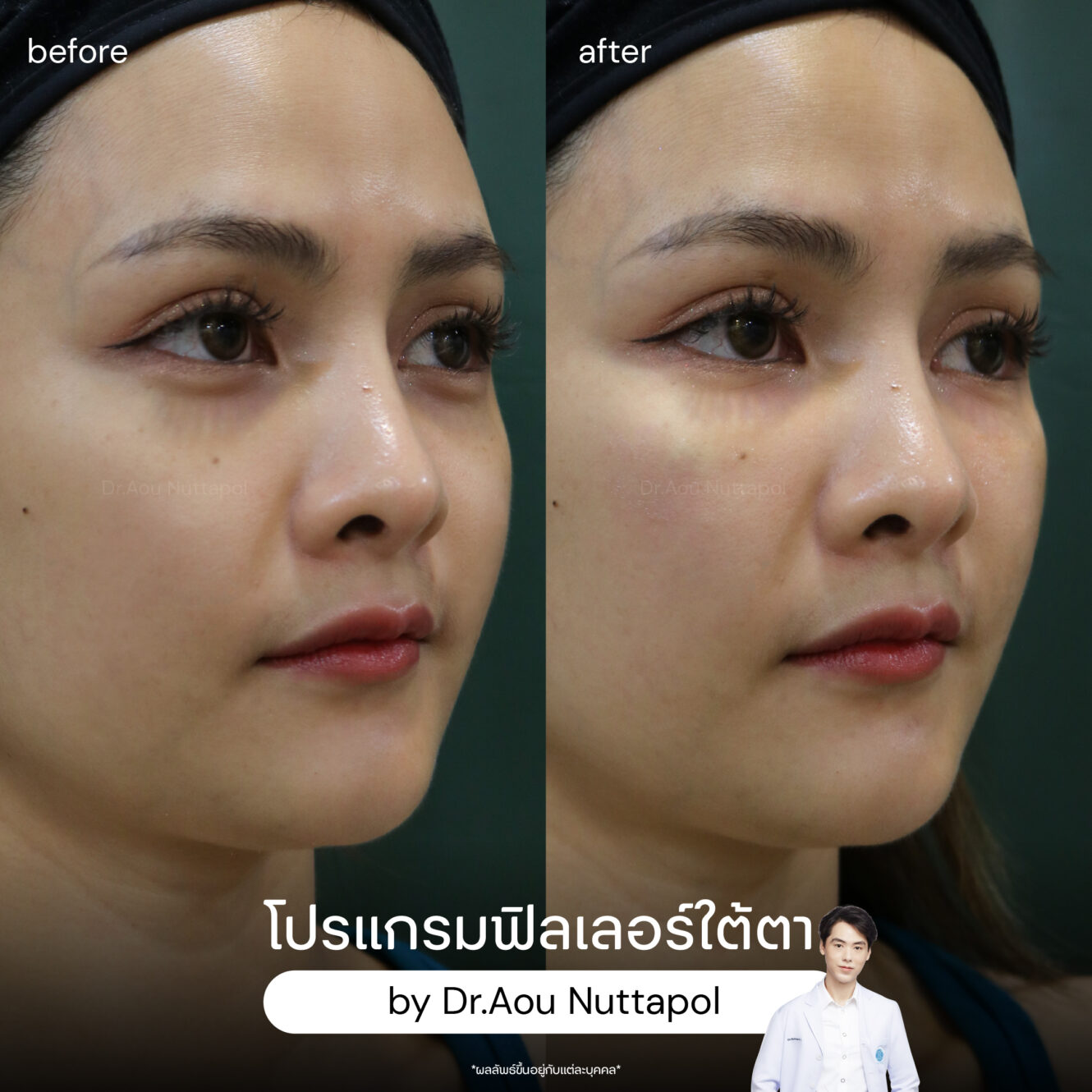 BA filler ใต้ตา 02