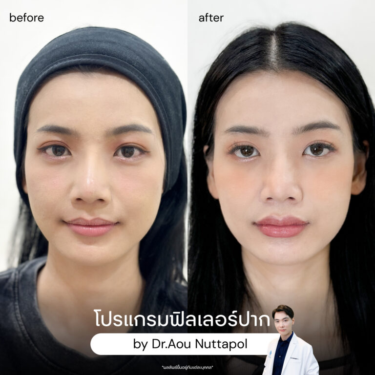 ฉีดฟิลเลอร์ปากครั้งแรกต้องรู้อะไรบ้าง? ราคาเท่าไหร่ อยู่ได้ประมาณแค่ไหน 9