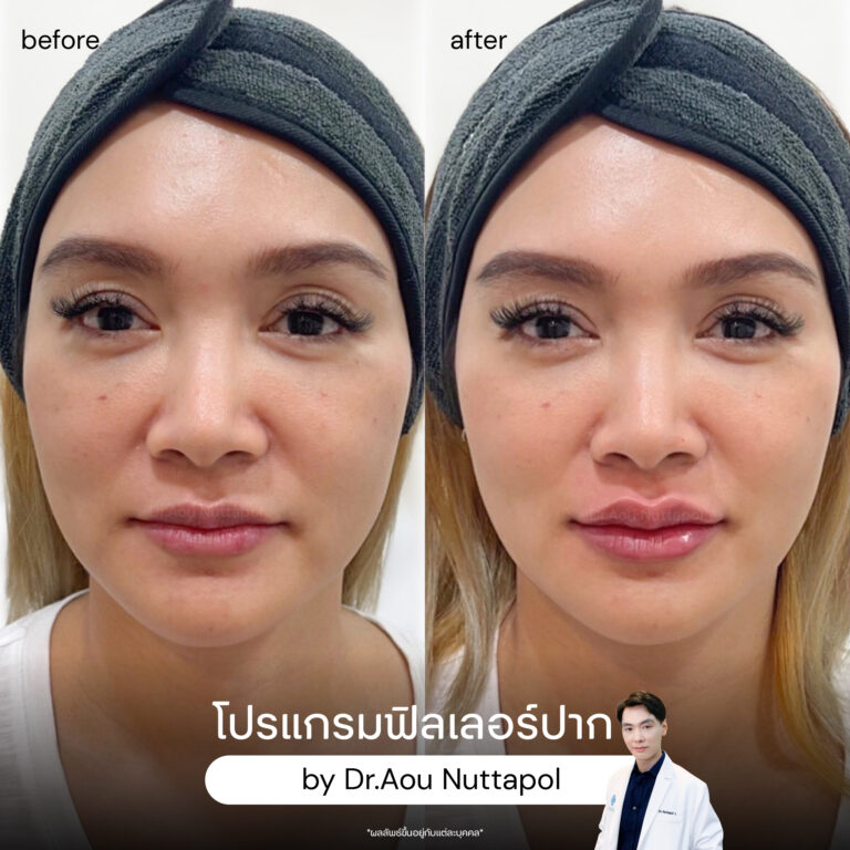ฉีดฟิลเลอร์ปากครั้งแรกต้องรู้อะไรบ้าง? ราคาเท่าไหร่ อยู่ได้ประมาณแค่ไหน 8 lip-filler-review
