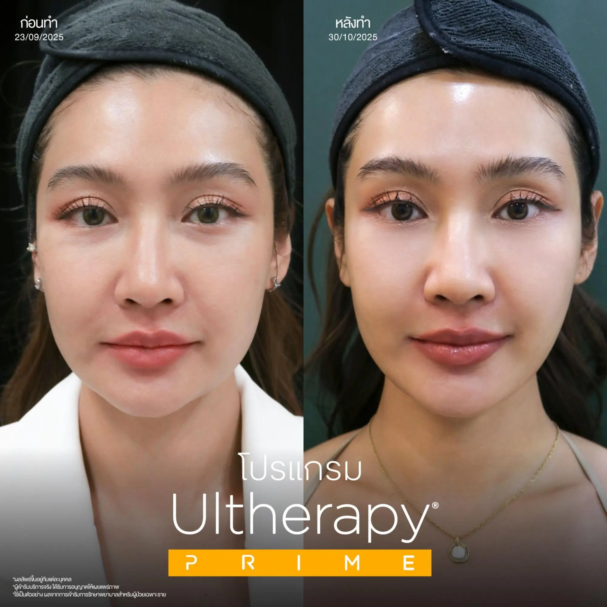 โปรแกรม Ulthera Prime ยกกระชับผิวที่ได้ผลประทับใจกว่าเดิม! 4 เช็กก่อนทำโปรแกรม Ulthera Prime เหมาะกับปัญหาผิวของคุณมากแค่ไหน