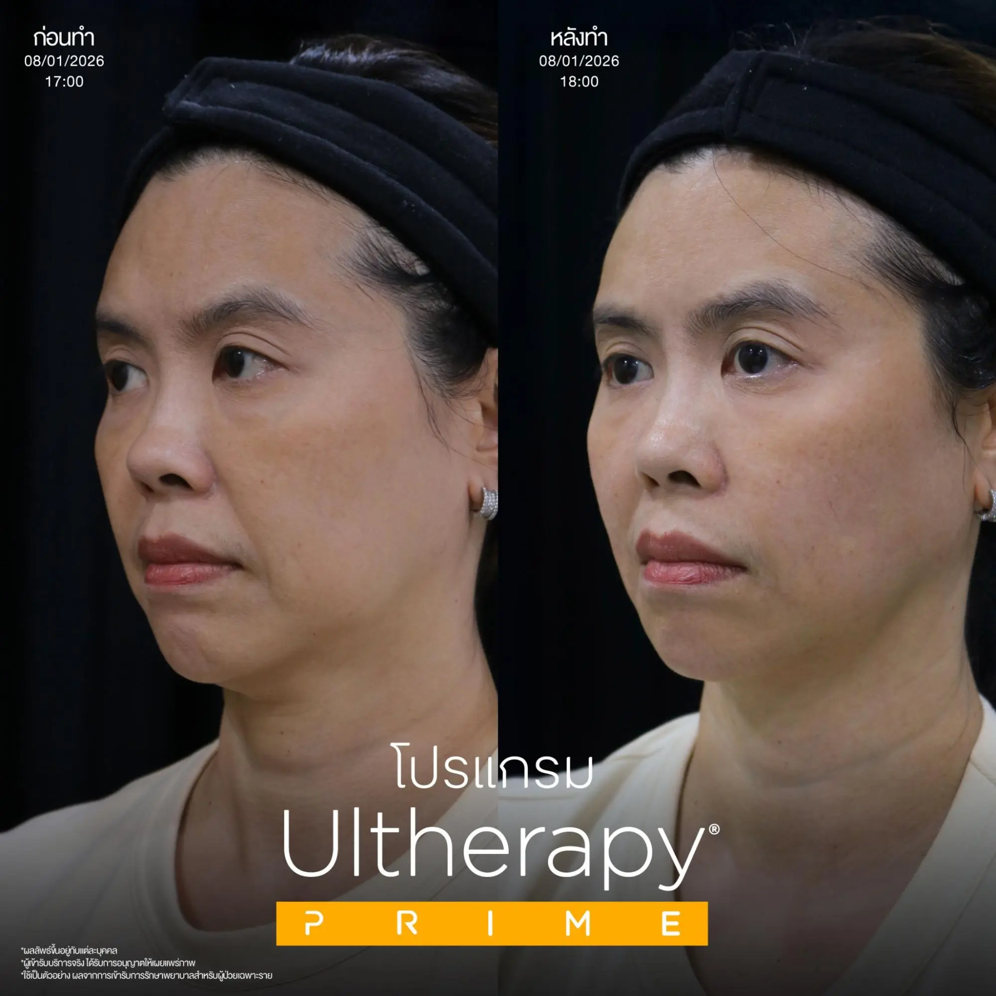 โปรแกรม Ulthera Prime ยกกระชับผิวที่ได้ผลประทับใจกว่าเดิม! 6 รีวิวก่อนหลังทำโปรแกรม Ulthera Prime ที่ INFINIZ Clinic