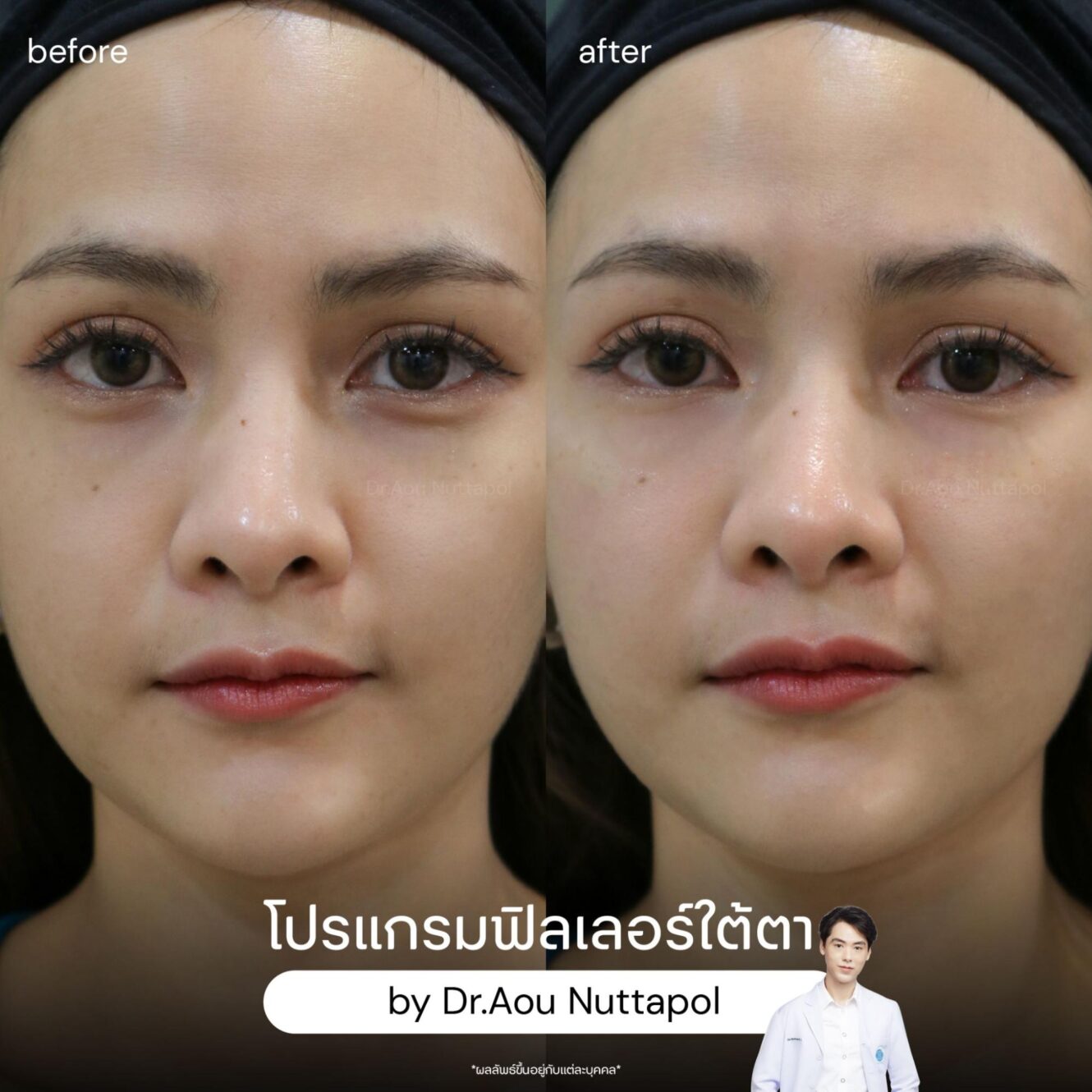โปรแกรมฟิลเลอร์ใต้ตาอยู่ได้นานไหม? ไขข้อสงสัยก่อนเข้ารับบริการ 3 ฟิลเลอร์ใต้ตาอยู่ได้นานไหม