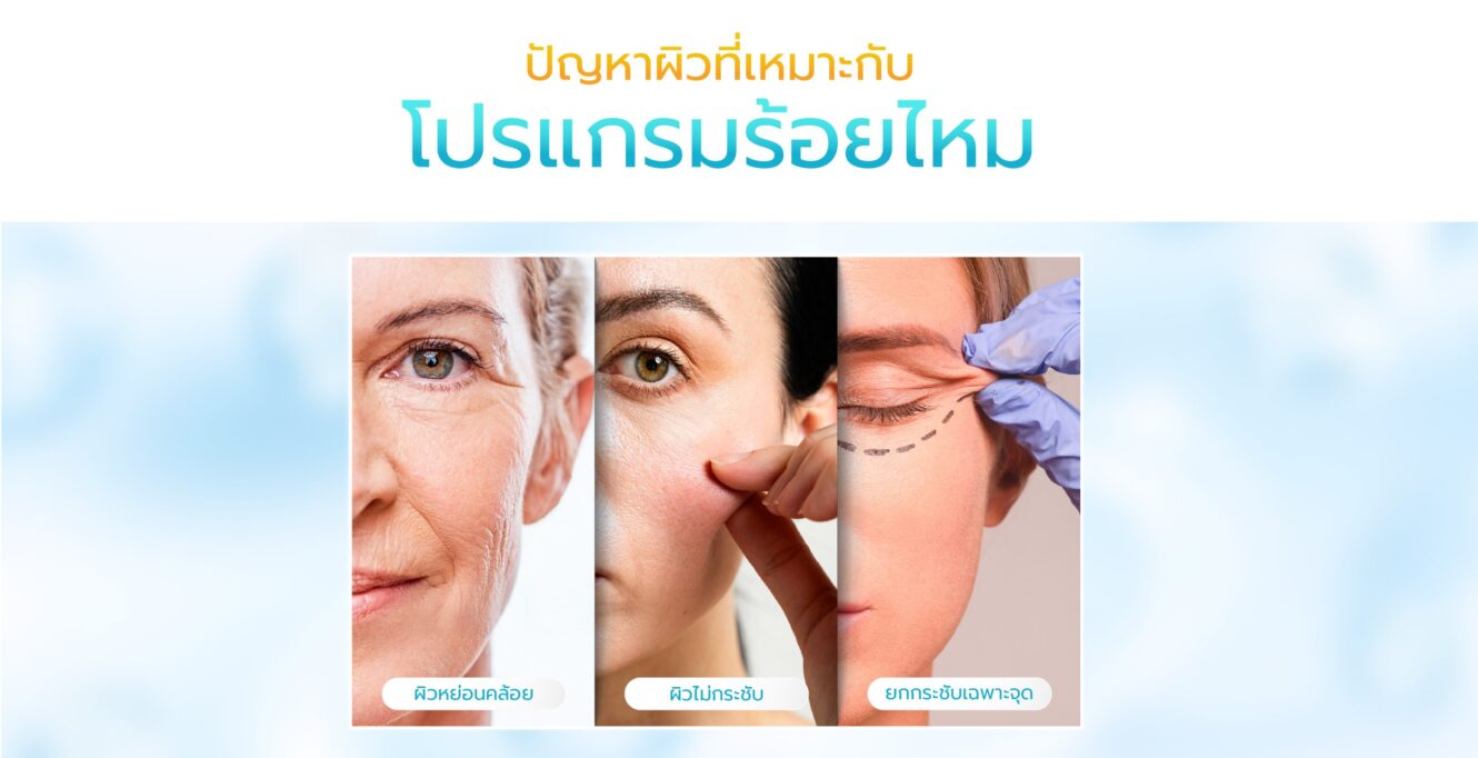 โปรแกรมร้อยไหม คืนความอ่อนเยาว์กระชับผิวโดยไม่ต้องผ่าตัด 5 00 Guideline Thread Lift 1