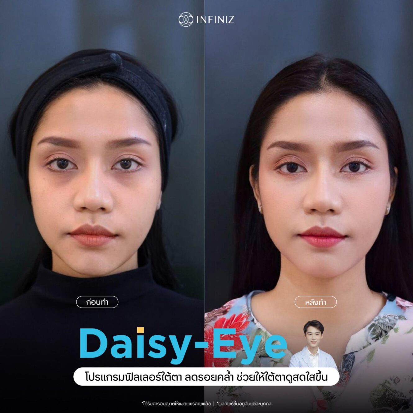 โปรแกรมฉีดฟิลเลอร์ใต้ตากี่วันเห็นผล? บวมนานไหม กี่วันยุบ? ควรดูแลตัวเองอย่างไร 2 ฟิลเลอร์ใต้ตา กี่วันเห็นผล