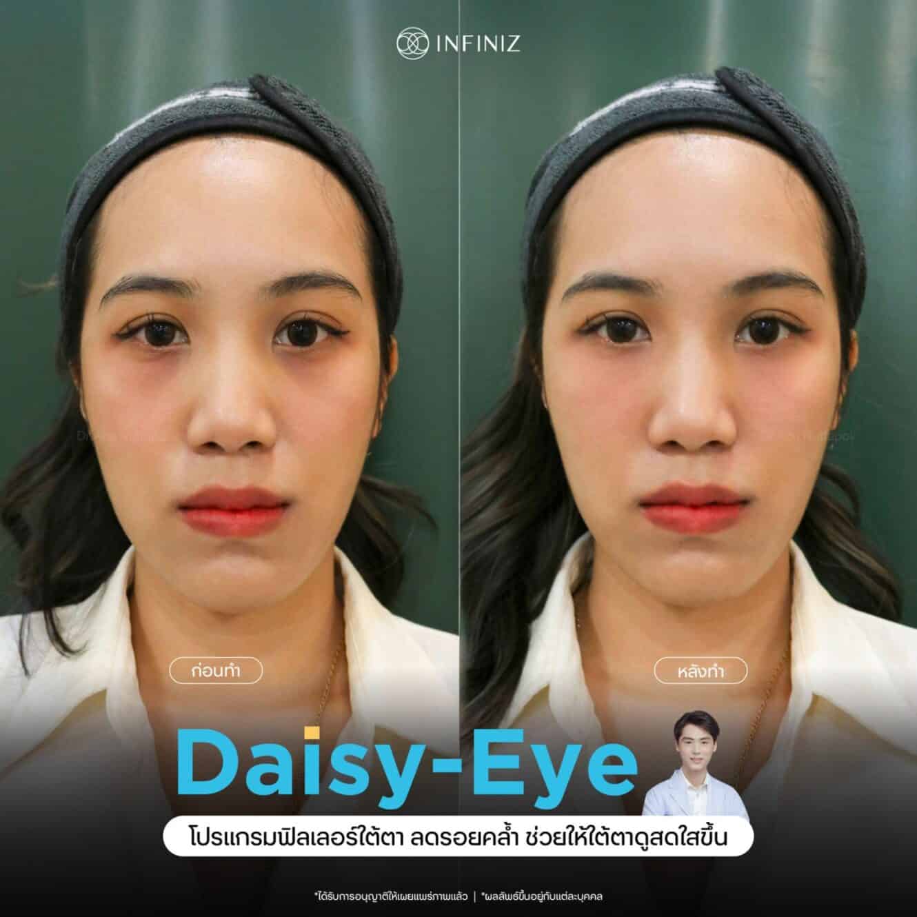โปรแกรมฉีดฟิลเลอร์ใต้ตากี่วันเห็นผล? บวมนานไหม กี่วันยุบ? ควรดูแลตัวเองอย่างไร 3 รีวิวฟิลเลอร์ใต้ตา กี่วันเห็นผล