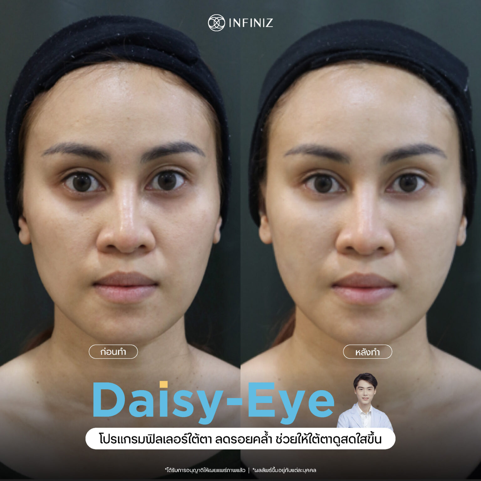 web B&A - eyes-12