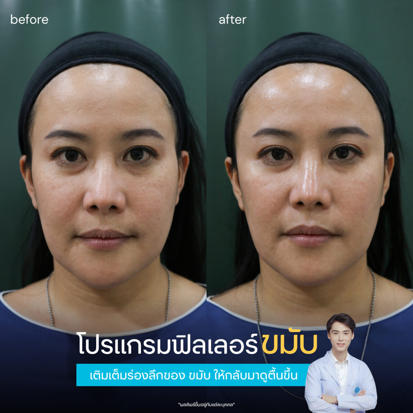 BA Filler ขมับ 01 1