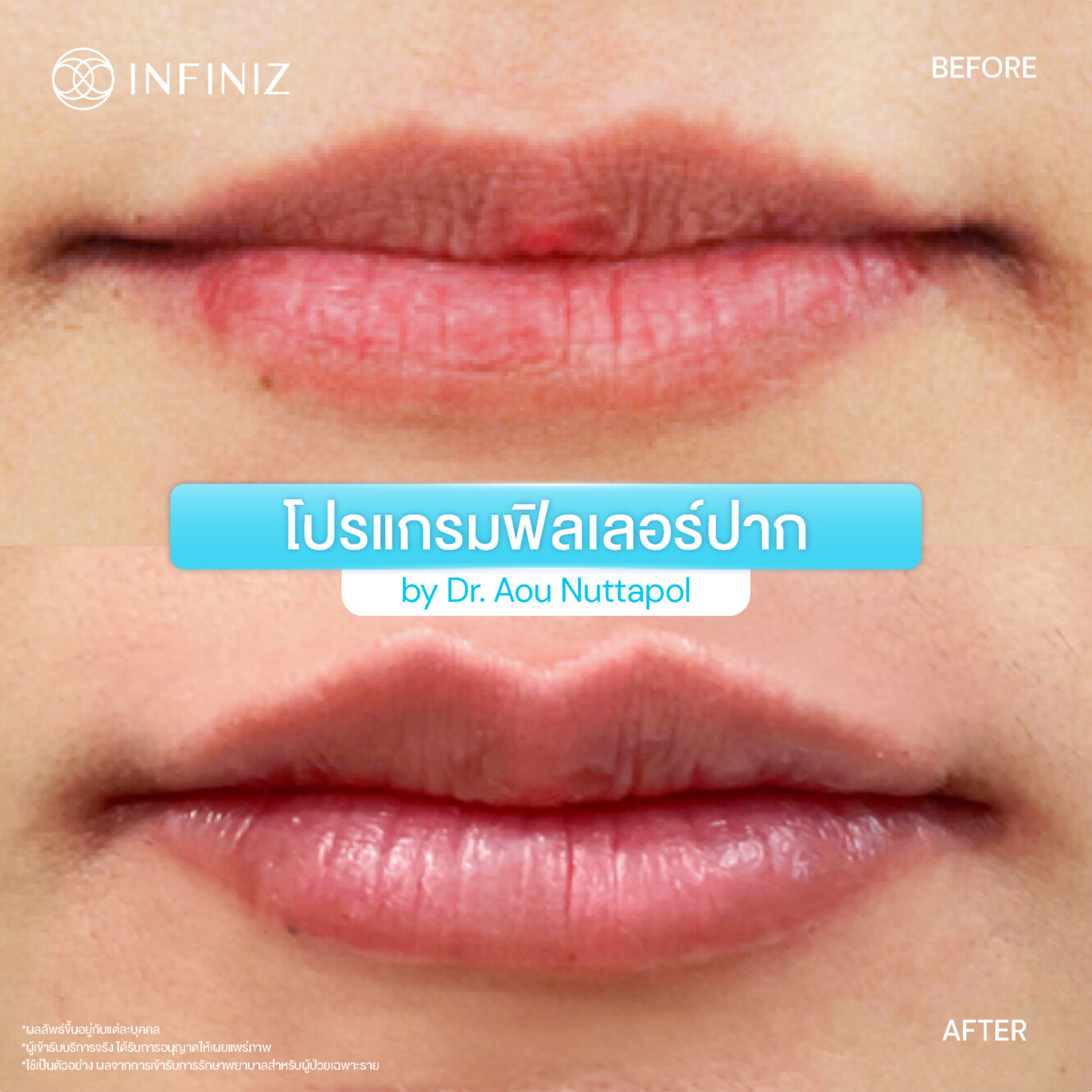 BA Lip Aug 25 02
