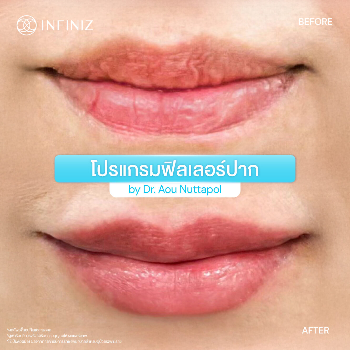 BA Lip Aug 25 08