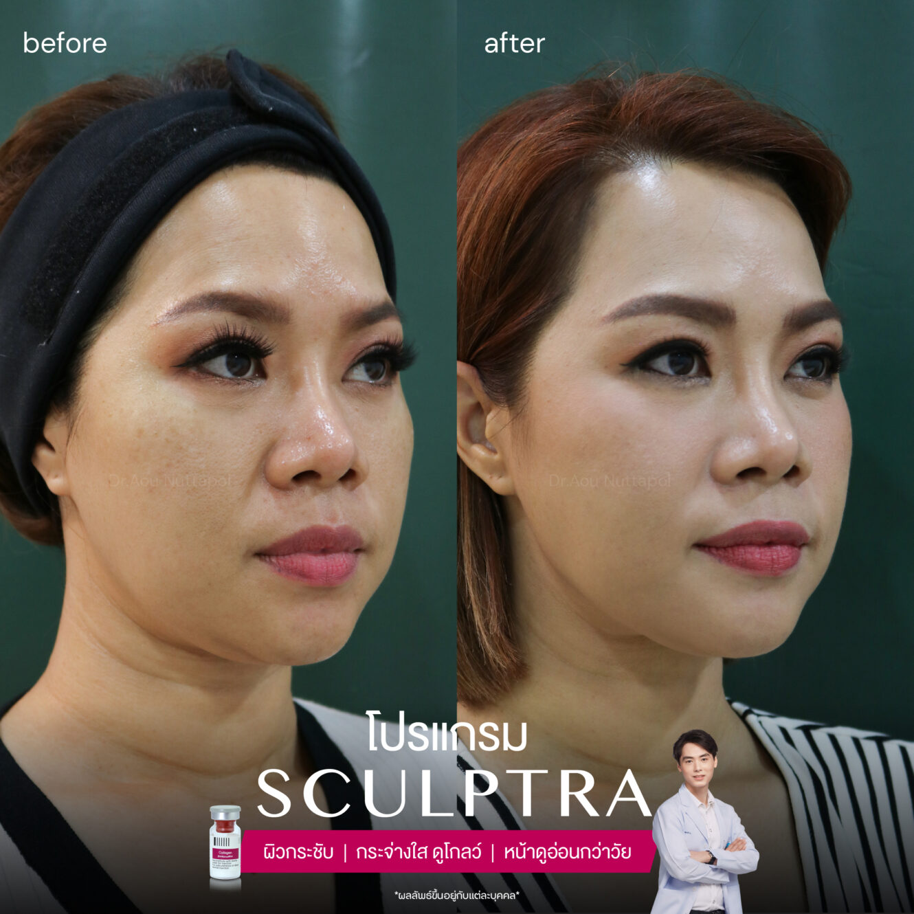 BA Sculptra 05 1 1