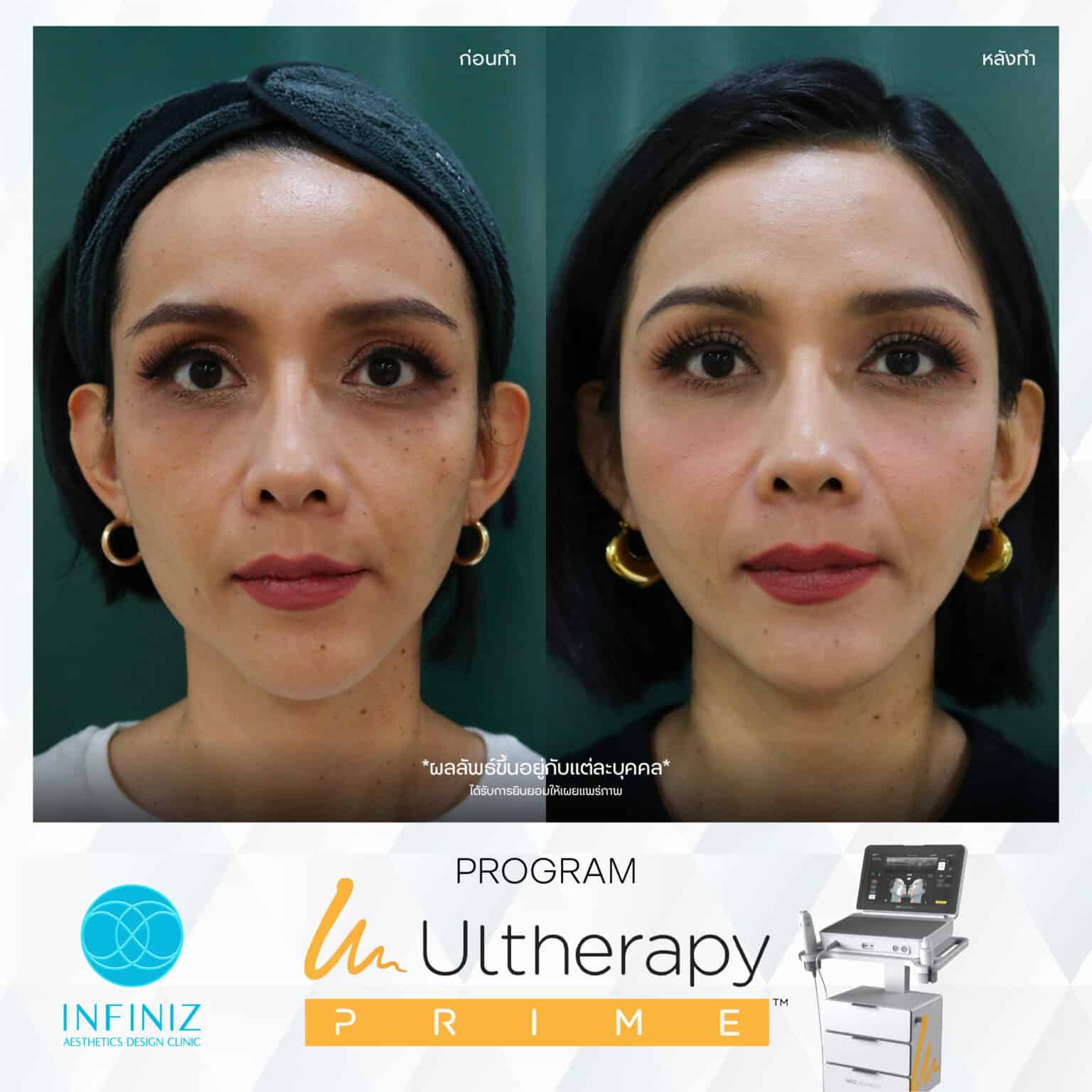 Ulthera Program by Infiniz Clinic 17 Prime - Mar 25-02