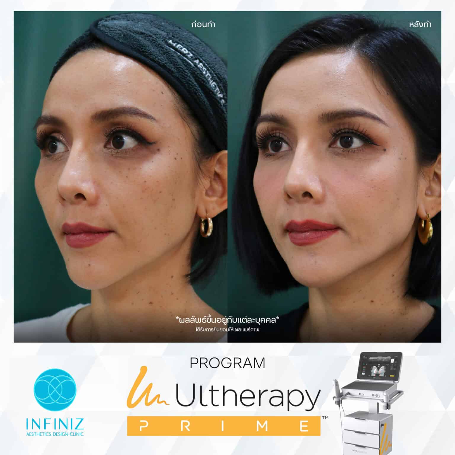 Ulthera Program by Infiniz Clinic 18 Prime - Mar 25-03