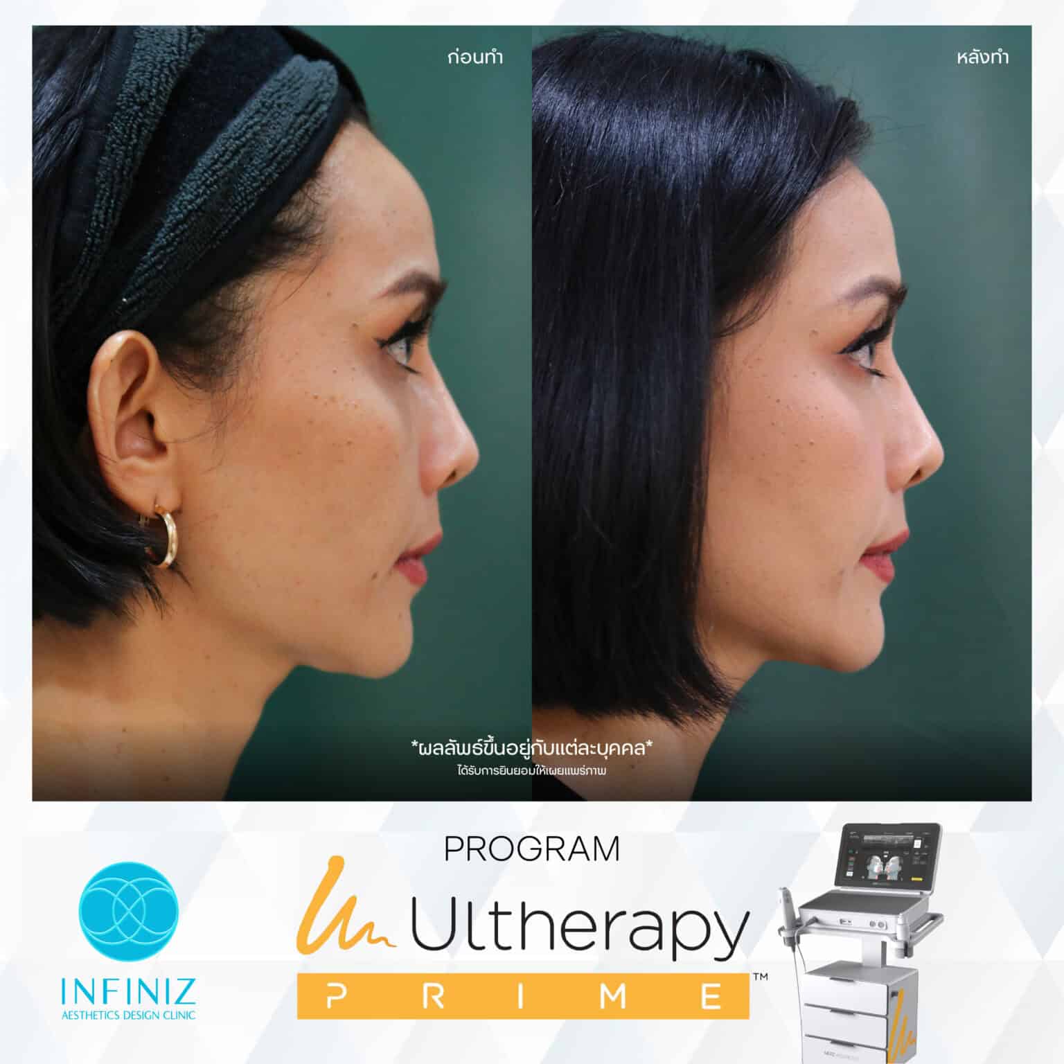 Ulthera Program by Infiniz Clinic 19 Prime - Mar 25-04