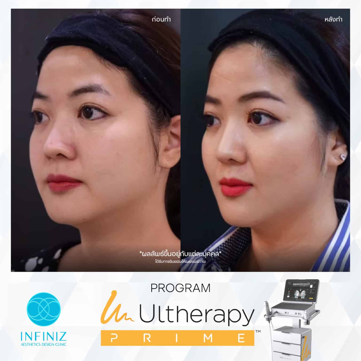 Ulthera Program by Infiniz Clinic 20 Prime - Mar 25-05