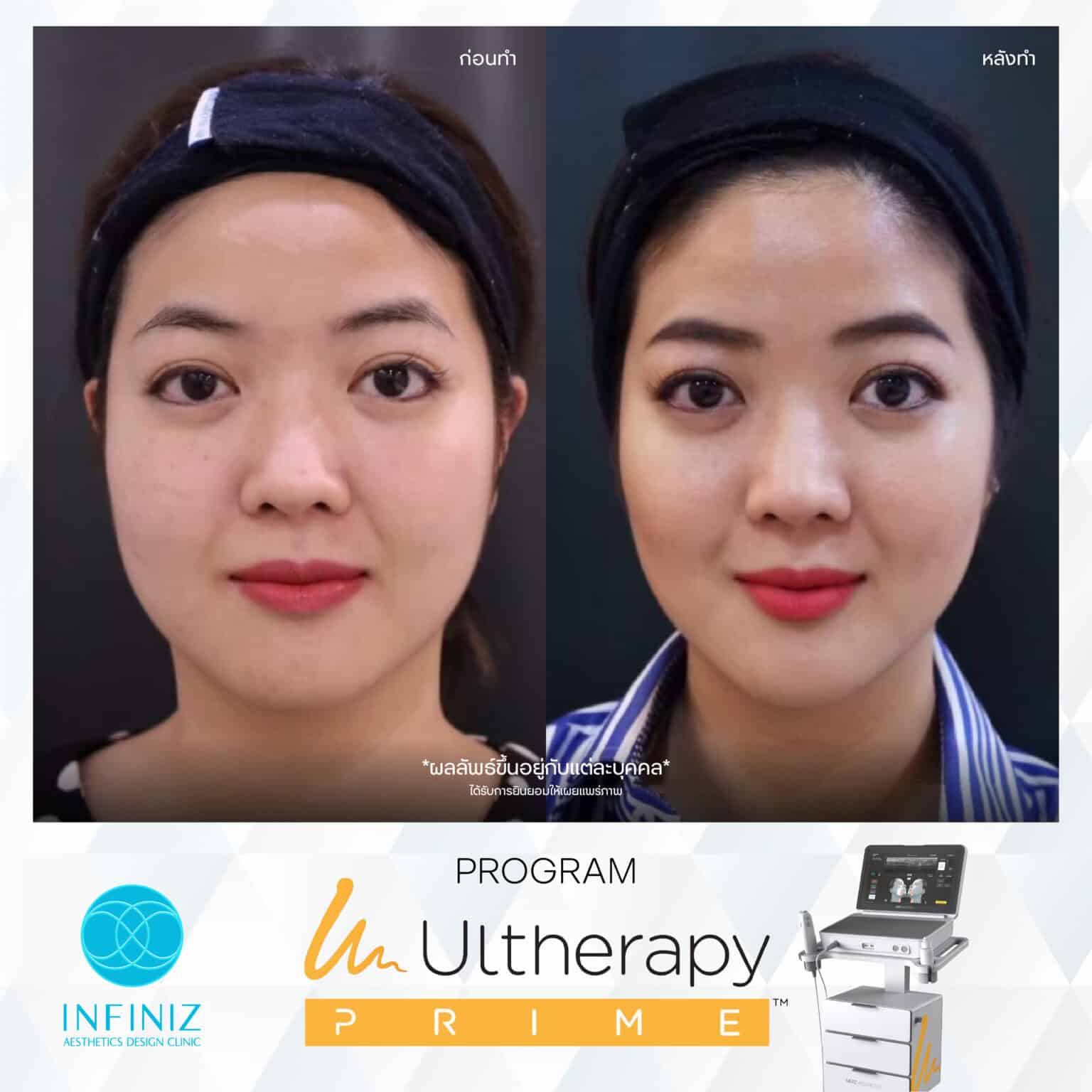 Ulthera Program by Infiniz Clinic 21 Prime - Mar 25-06