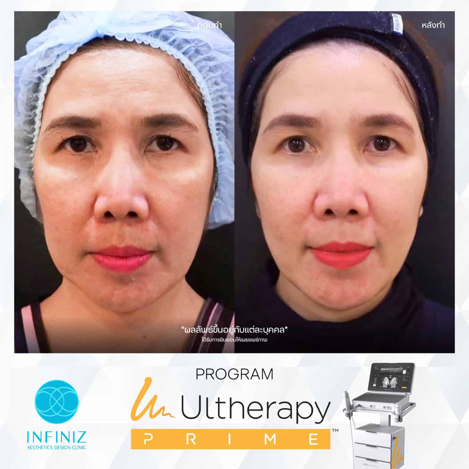 Ulthera Program by Infiniz Clinic 27 Prime - Mar 25-07