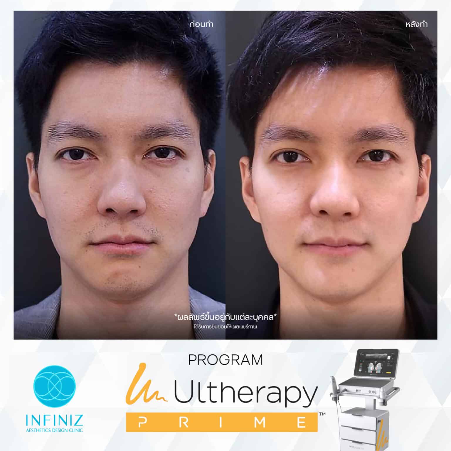 Ulthera Program by Infiniz Clinic 26 Prime - Mar 25-08