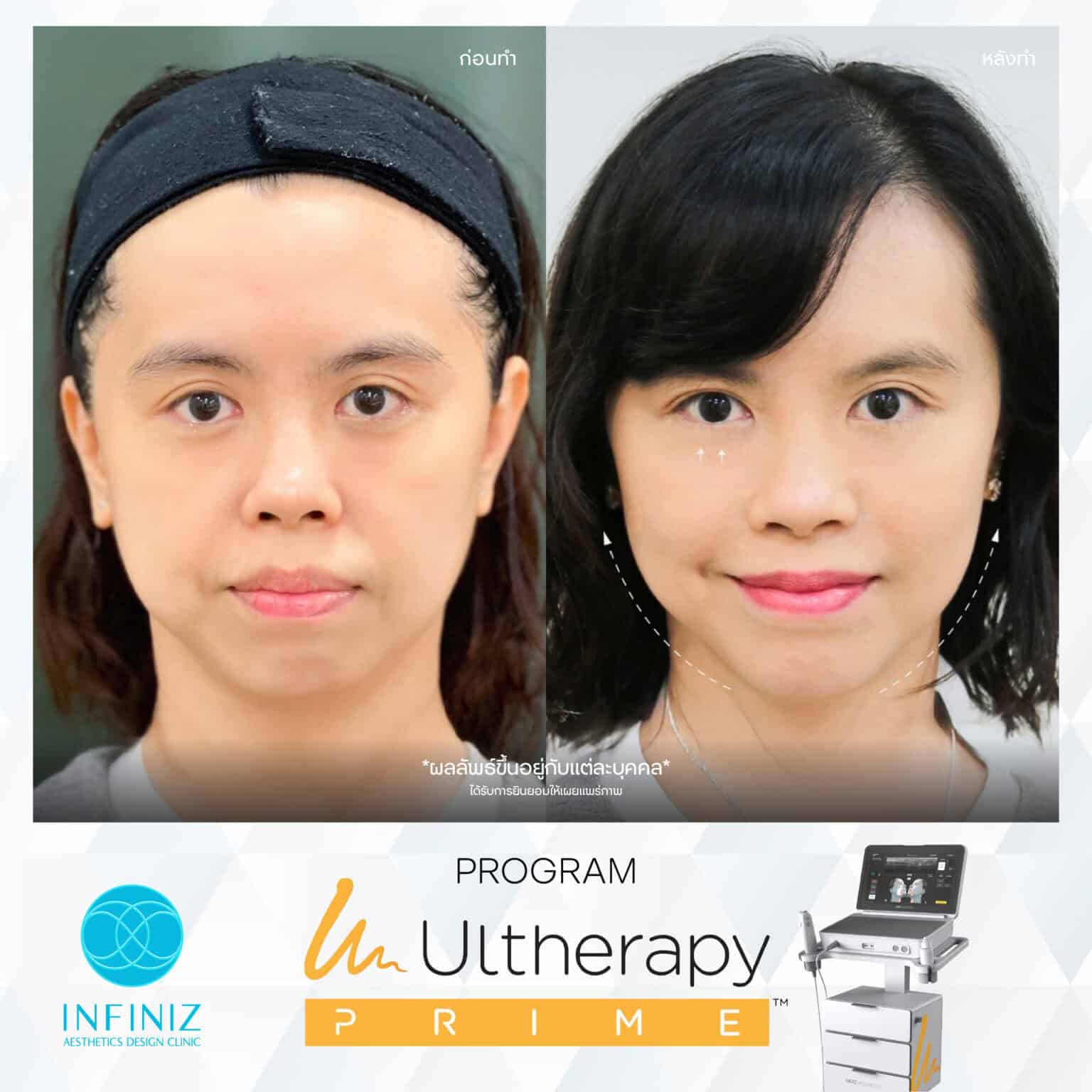 Ulthera Program by Infiniz Clinic 22 Prime - Mar 25-10