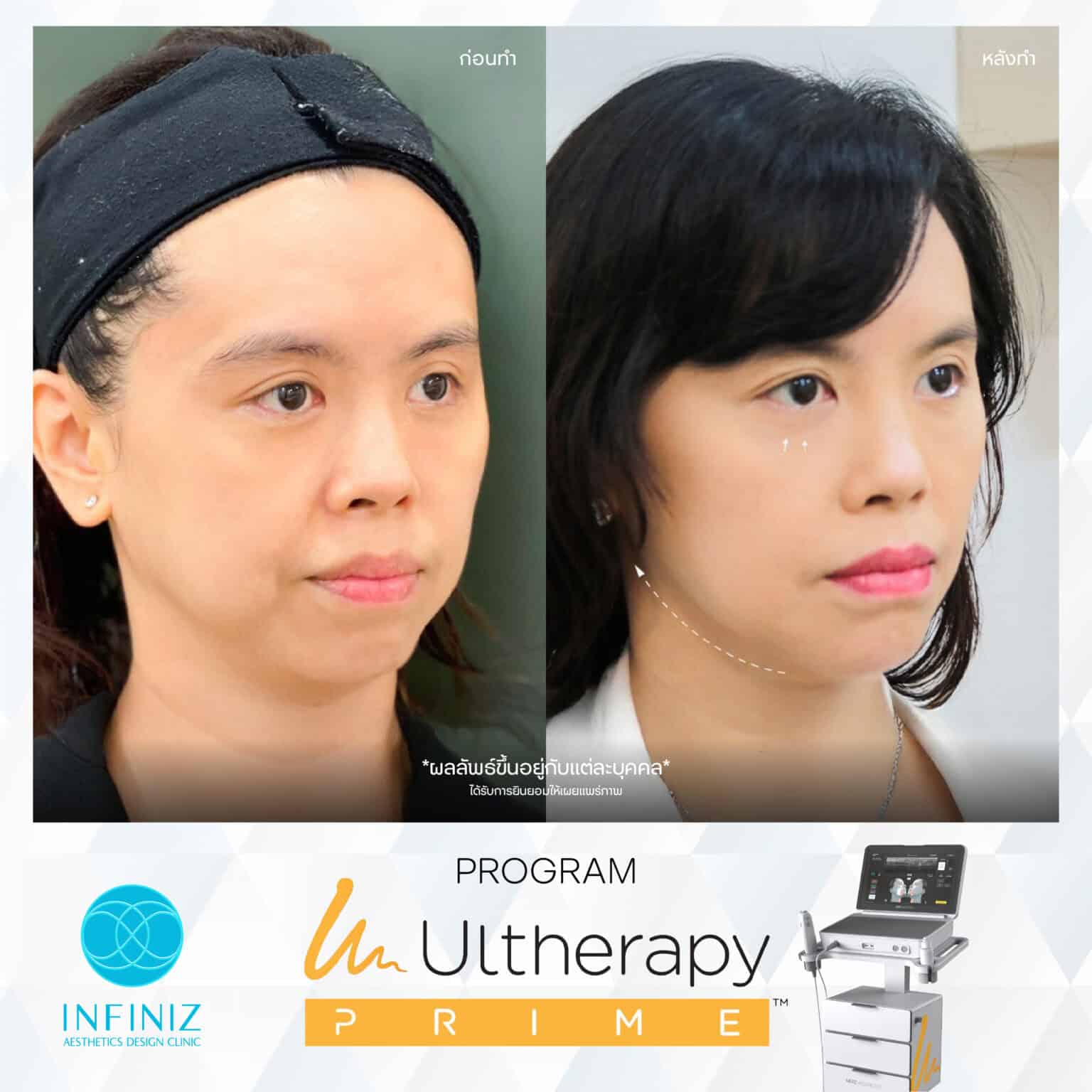 Ulthera Program by Infiniz Clinic 23 Prime - Mar 25-11