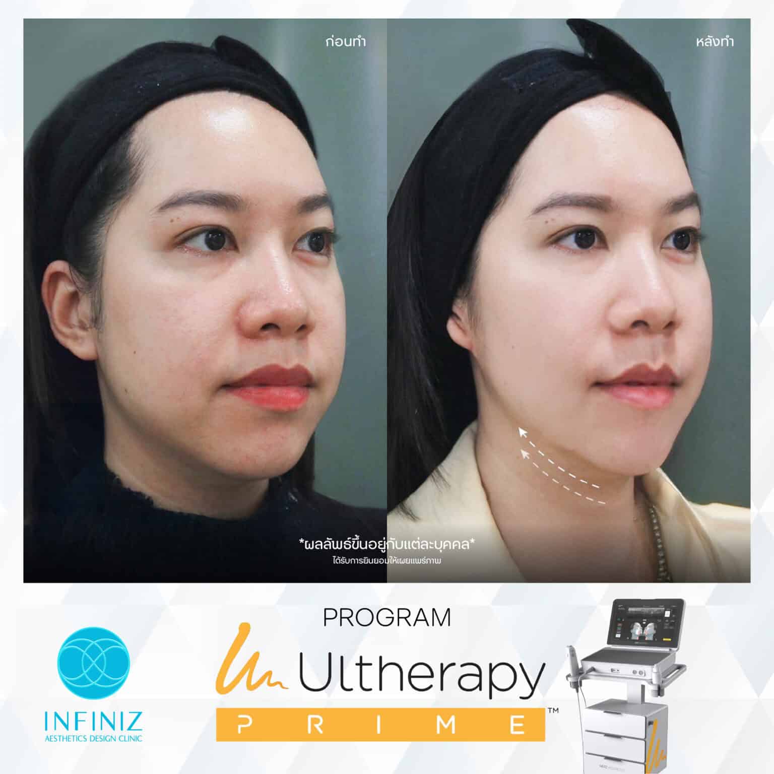Ulthera Program by Infiniz Clinic 25 Prime - Mar 25-13