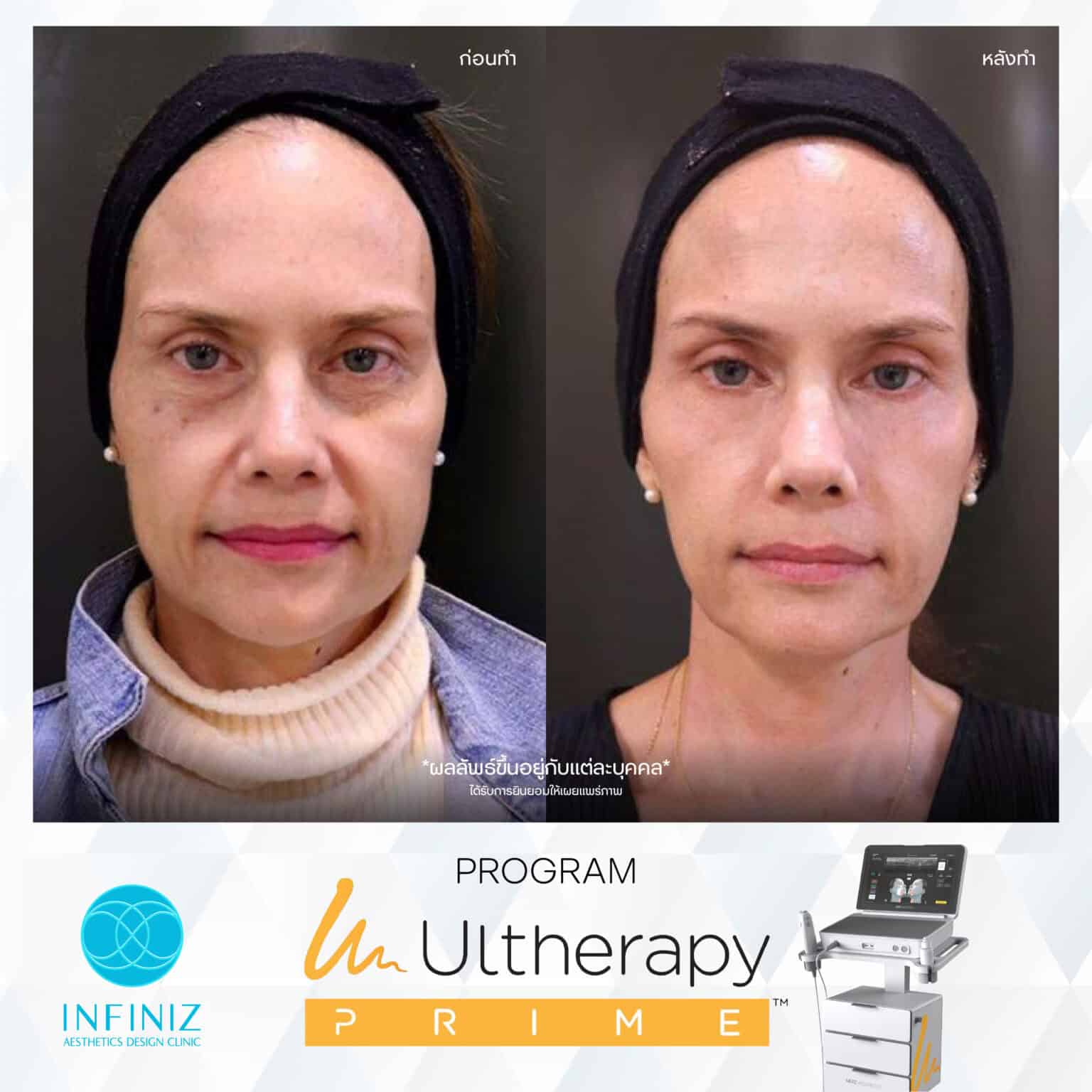 Ulthera Program by Infiniz Clinic 32 Prime - Mar 25-14
