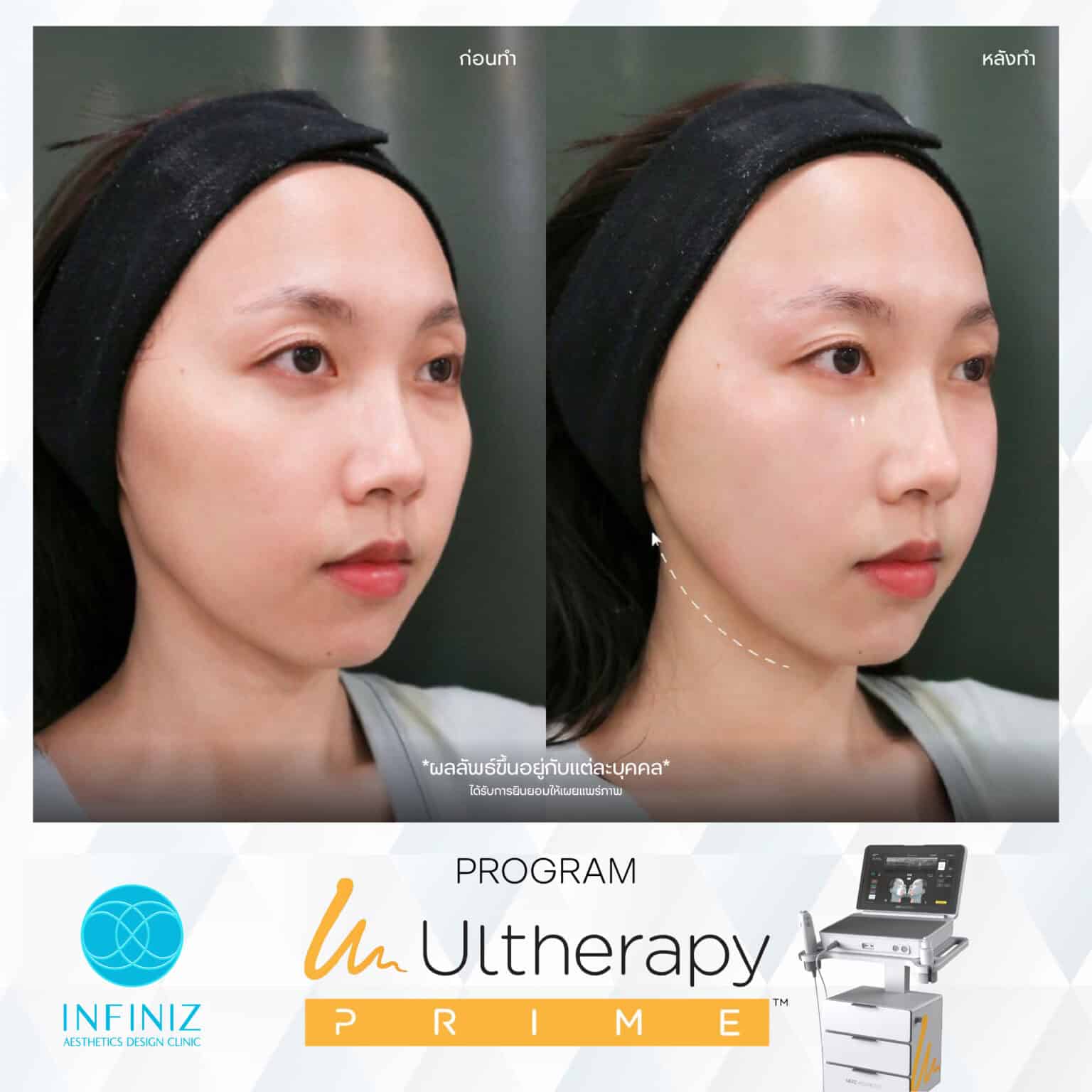 Ulthera Program by Infiniz Clinic 33 Prime - Mar 25-15