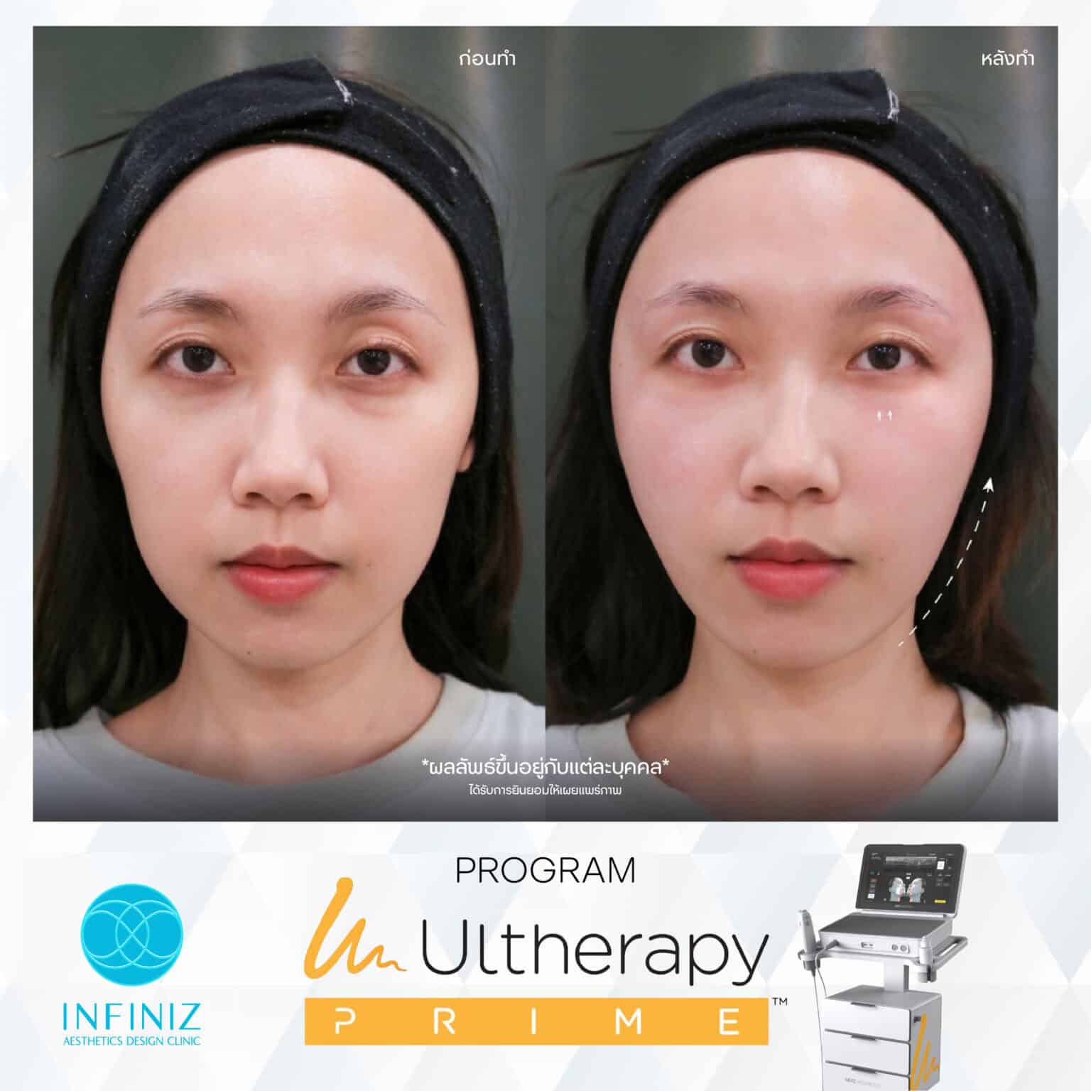 Ulthera Program by Infiniz Clinic 28 Prime - Mar 25-16