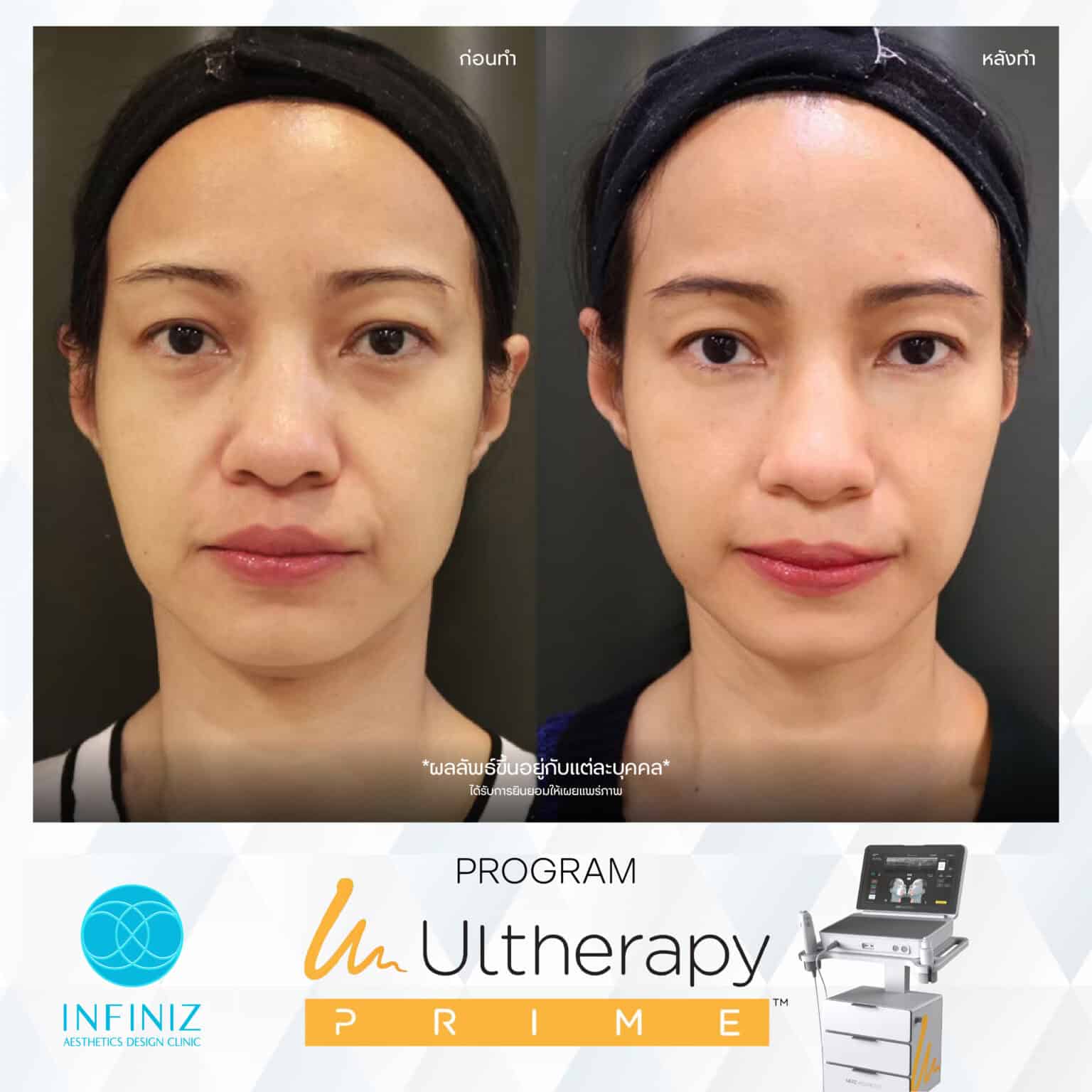 Ulthera Program by Infiniz Clinic 30 Prime - Mar 25-18