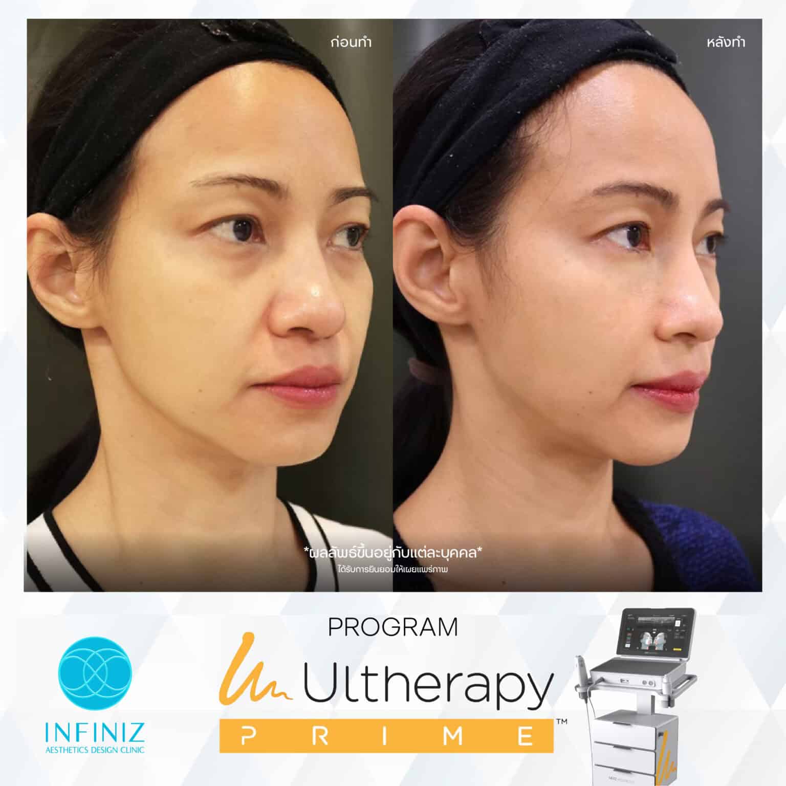 Ulthera Program by Infiniz Clinic 31 Prime - Mar 25-19
