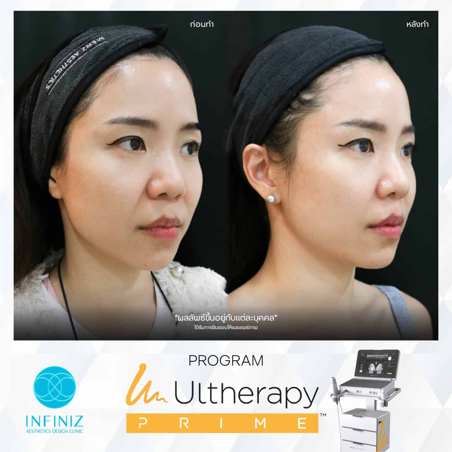 Ulthera Program by Infiniz Clinic 34 Prime - Mar 25-20