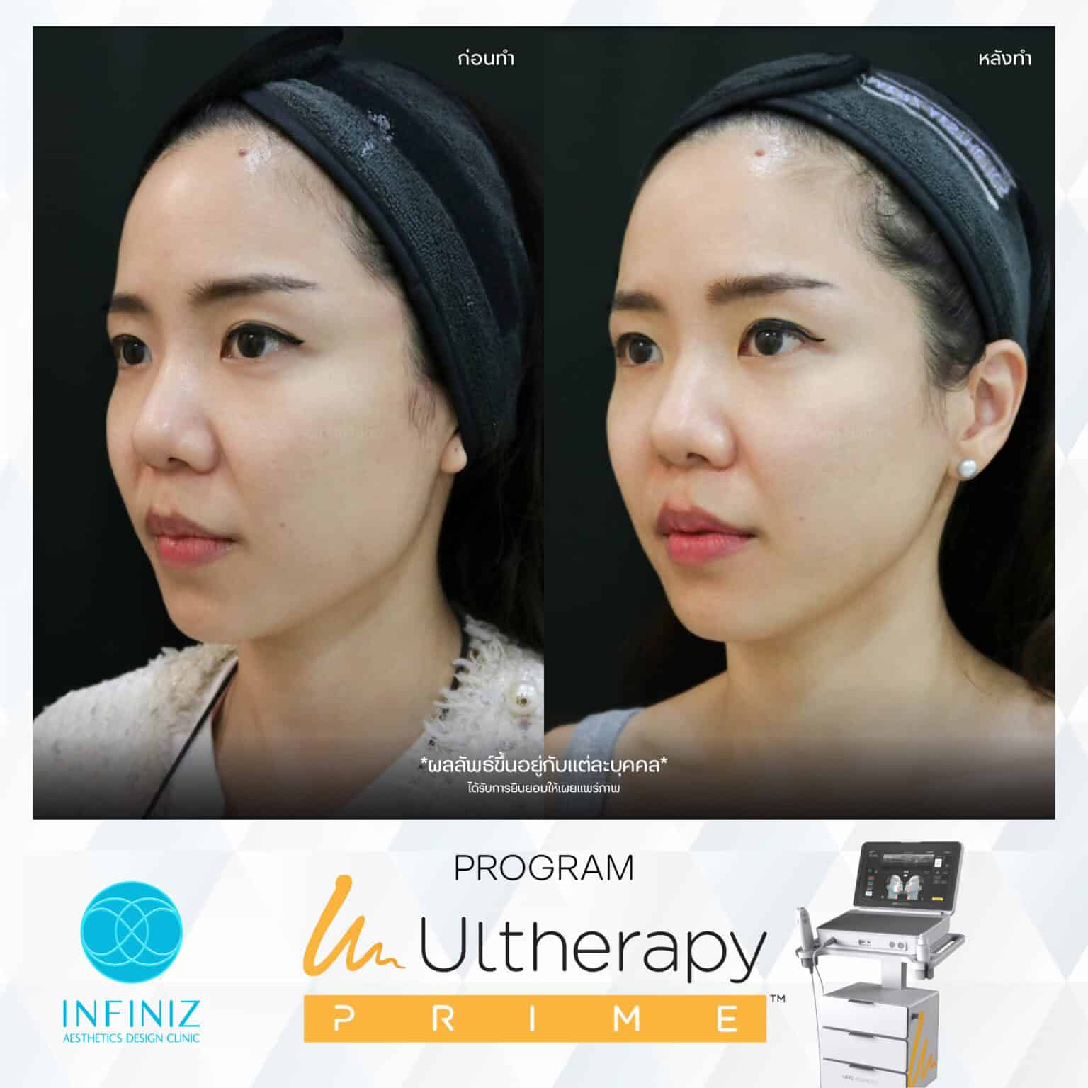 Ulthera Program by Infiniz Clinic 35 Prime - Mar 25-21