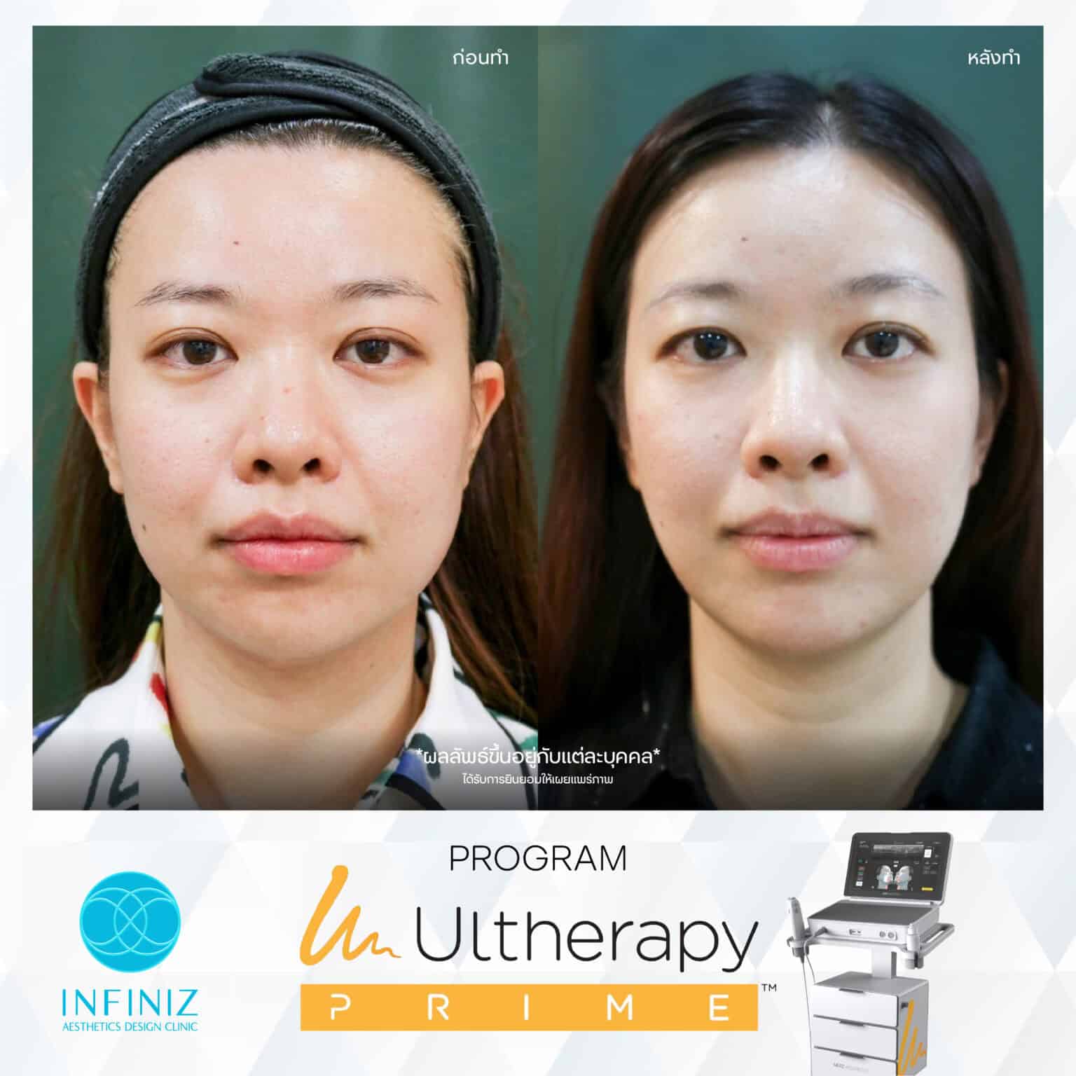Ulthera Program by Infiniz Clinic 37 Prime - Mar 25-23