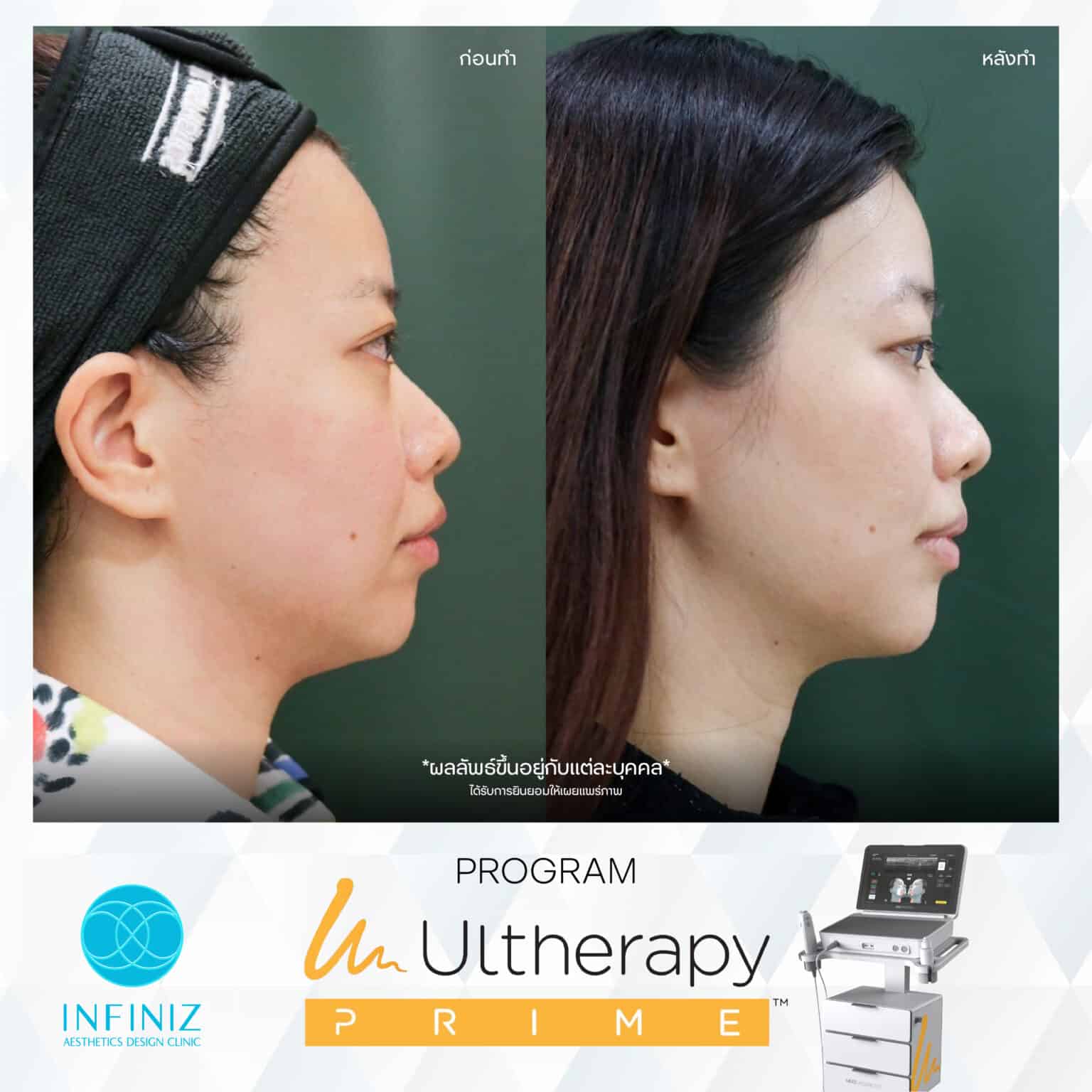 Ulthera Program by Infiniz Clinic 38 Prime - Mar 25-24