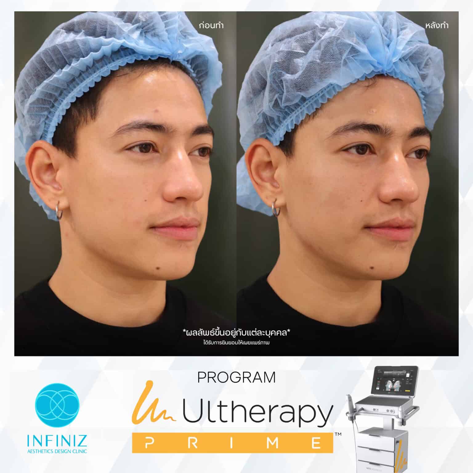 Ulthera Program by Infiniz Clinic 39 Prime - Mar 25-25