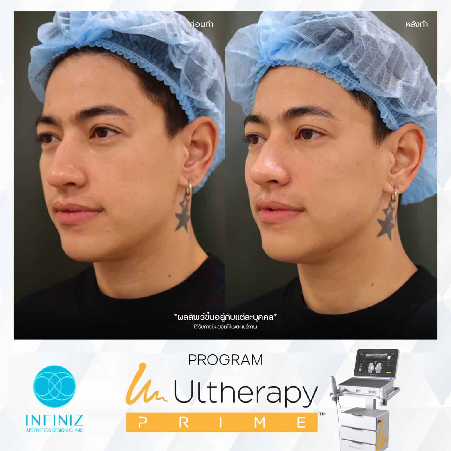 Ulthera Program by Infiniz Clinic 40 Prime - Mar 25-26