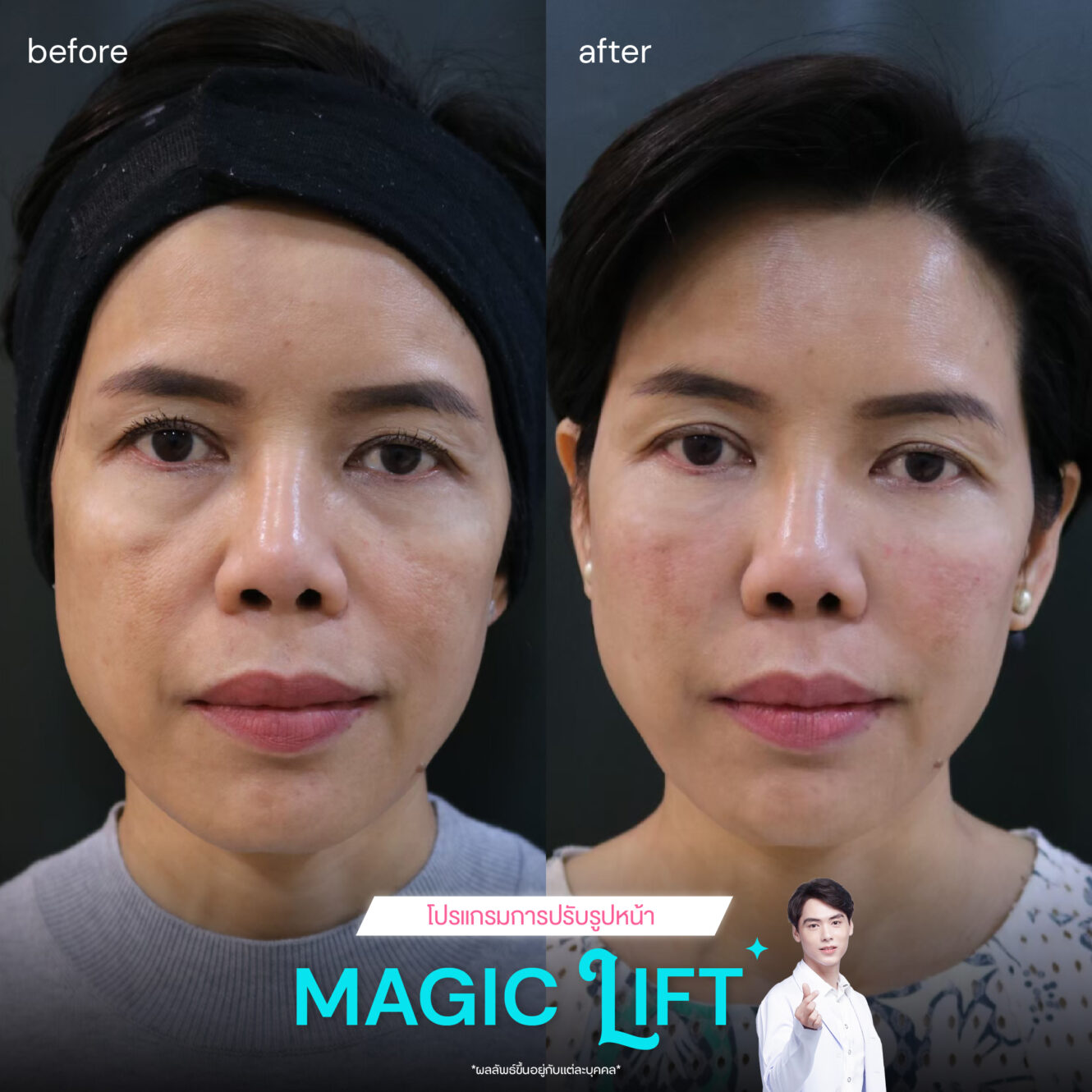 แพทย์ 6 BA Magic lift 01
