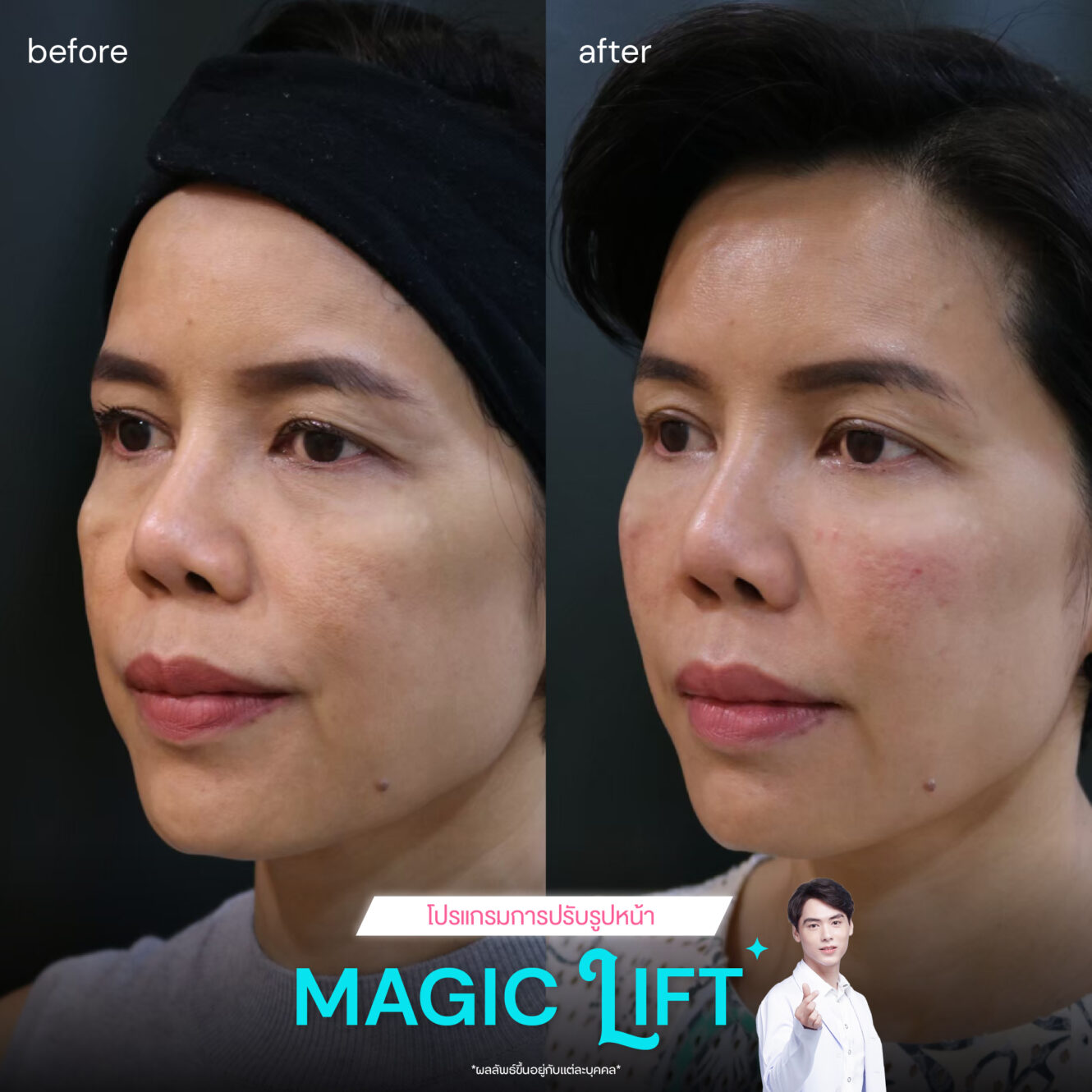แพทย์ 7 BA Magic lift 02
